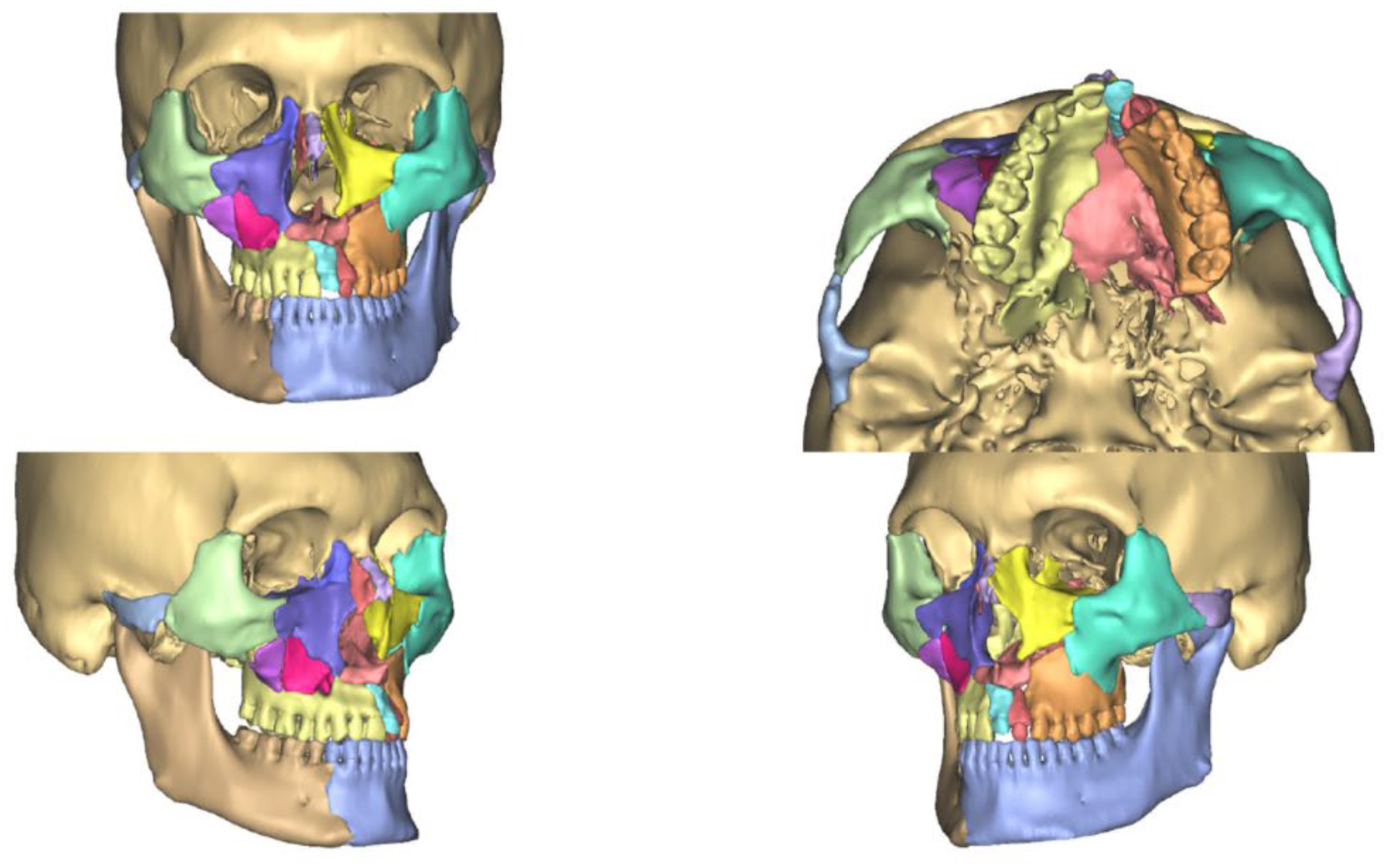 A four-view composite of C T reconstruction scans depicts color-segmented fractured midface and mandibular subunits repositioned into ideal alignment for virtual surgical reconstruction.