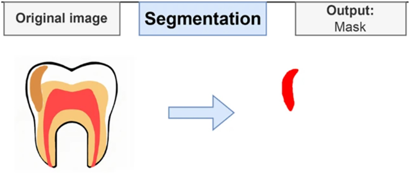 A diagram demonstrates mask removal of a carious area from a tooth using D L segmentation showing the original image and the segmented mask output.
