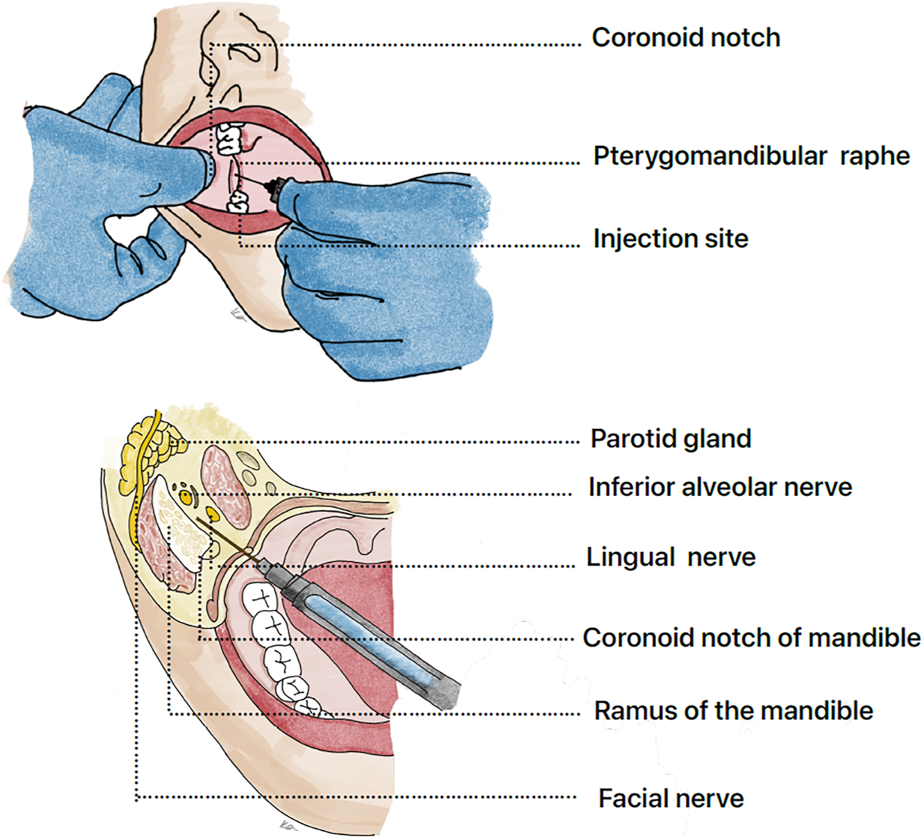 A procedural and anatomical diagram of the inferior alveolar nerve block labels extraoral landmarks, intraoral injection site, and associated nerves and structures in the mandible.