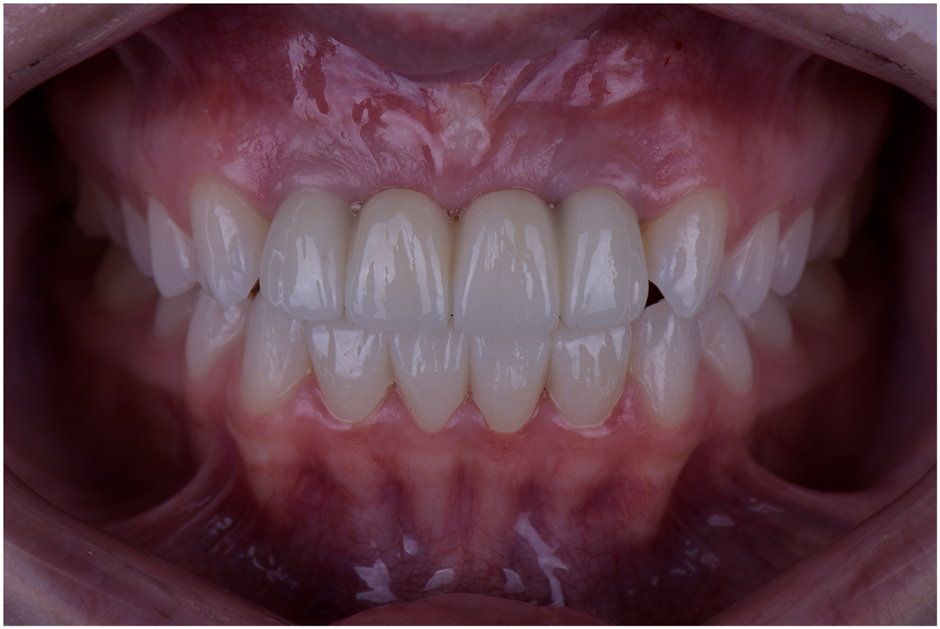 A clinical intraoral photograph showing the upper and lower teeth after placement of final implant-supported prostheses.
