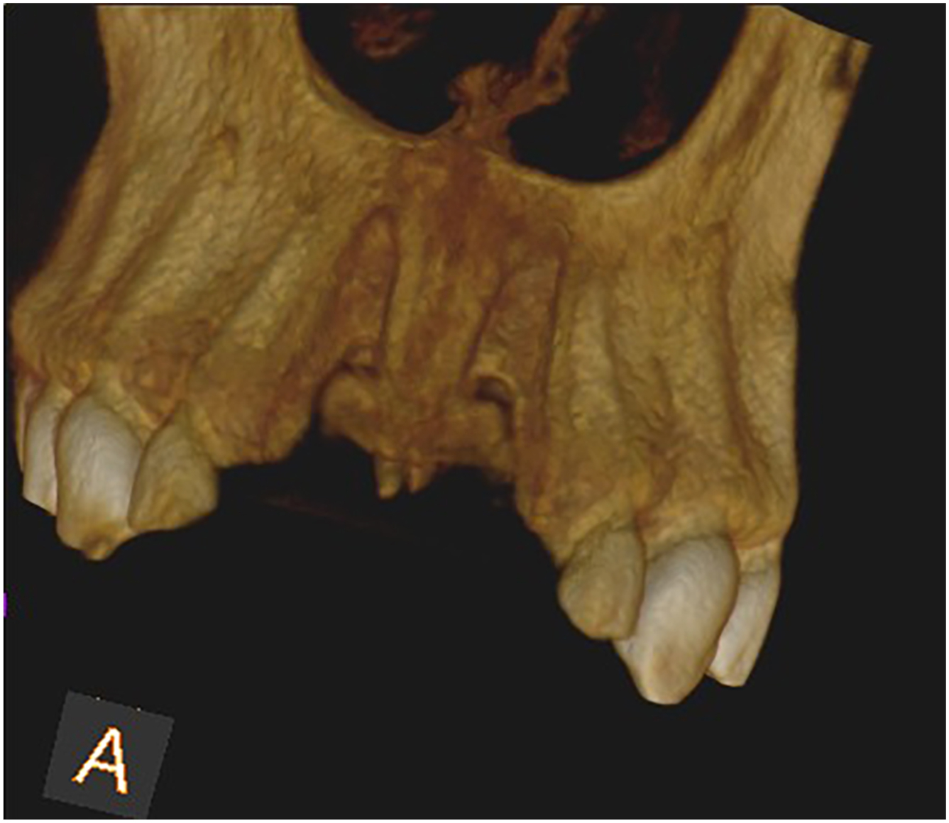 A three dimensional C B C T image of the anterior maxilla showing missing central incisors and fractures of the adjacent lateral incisors.