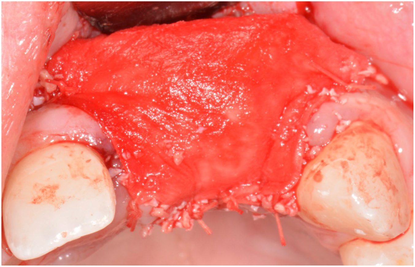 A close-up surgical intraoral view of the upper jaw shows that a bright protective membrane is placed over a bone graft site and secured tightly with small surgical stitches.