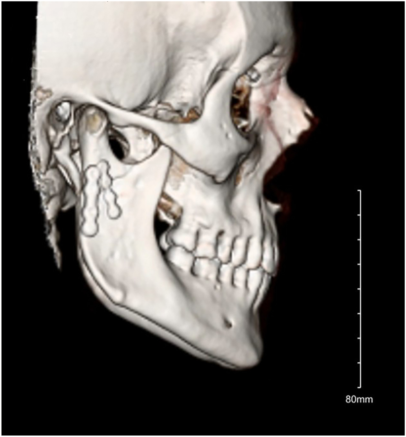 A postoperative 3 D reconstruction of a skull shows the stabilization of a mandibular fracture using two miniplates and screws.