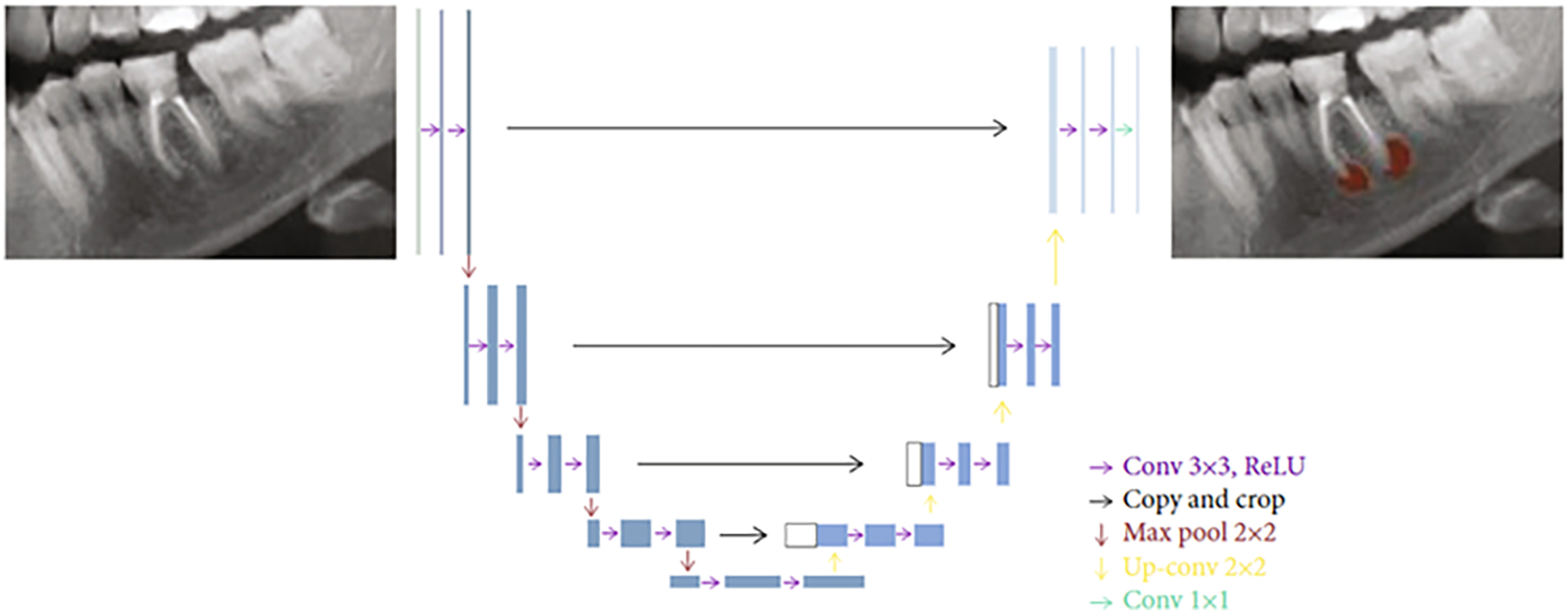 A diagram illustrates a semantic segmentation task for an apical lesion showing the progression from an original dental X-ray to a segmented mask.