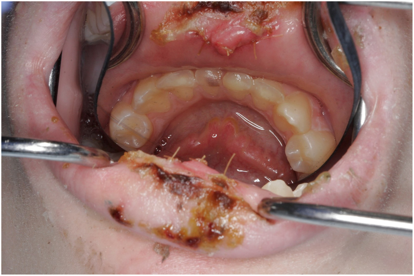 A clinical photograph showing the mouth held open with retractors and sutures placed in the upper and lower lip after injury.