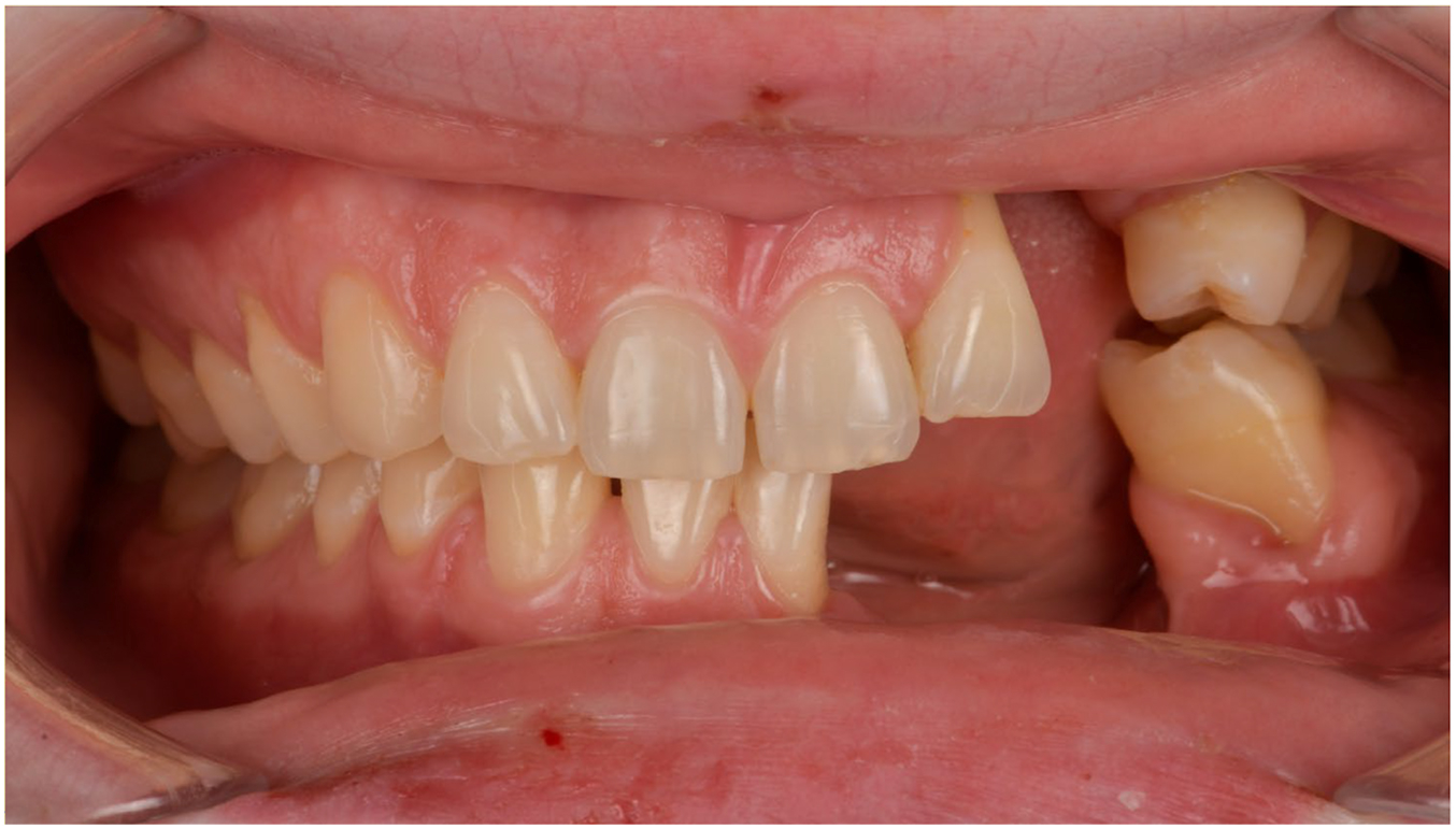 A close-up intraoral frontal view of a patient's mouth after healing shows massive, deep gum and bone tissue defects in the upper left jaw and severe gum recession exposing lower tooth roots.