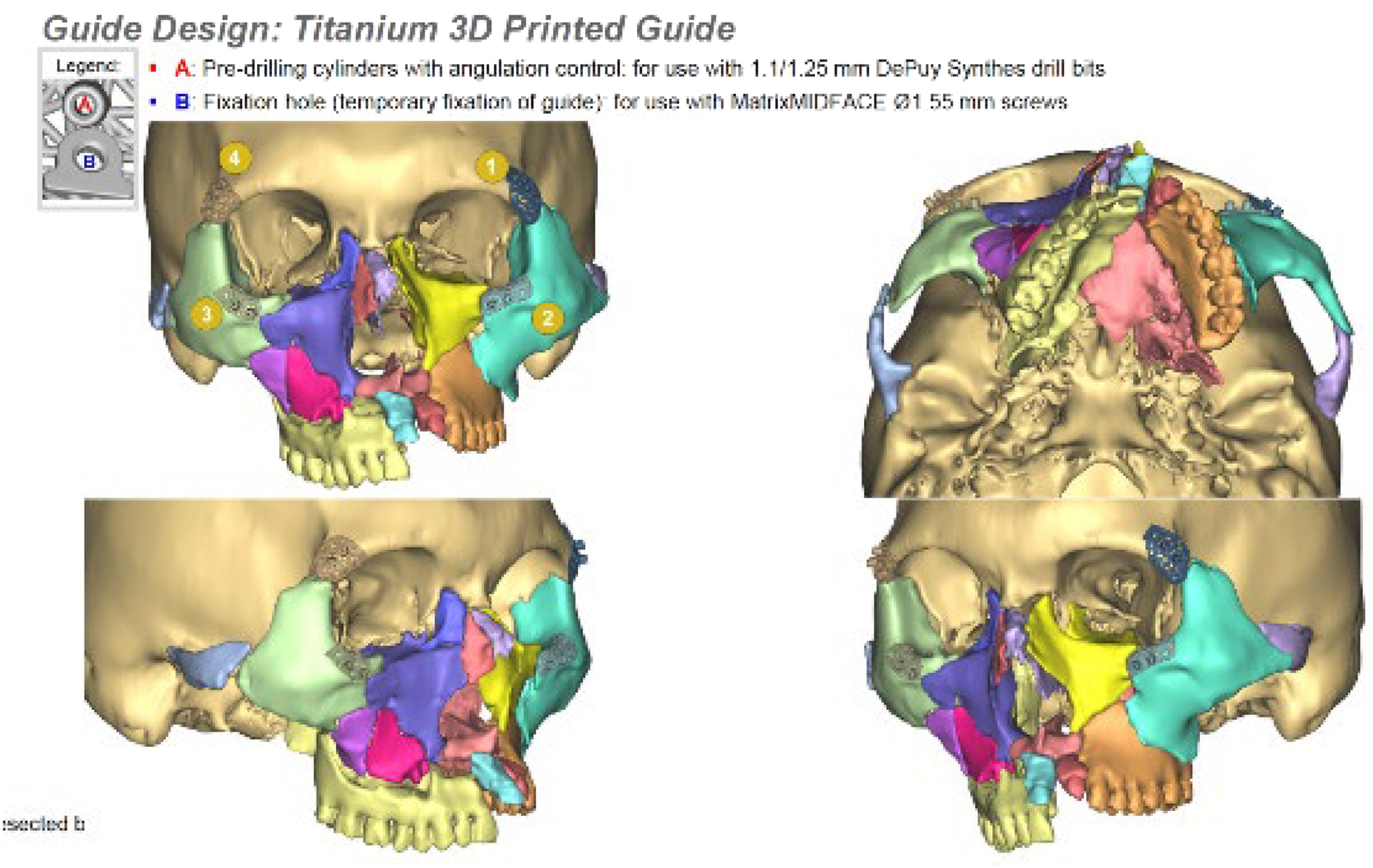 A four-view composite of C T reconstruction scans depicts four custom titanium three-dimensional printed surgical guides in place with pre-drilling cylinders and fixation holes, with a legend.