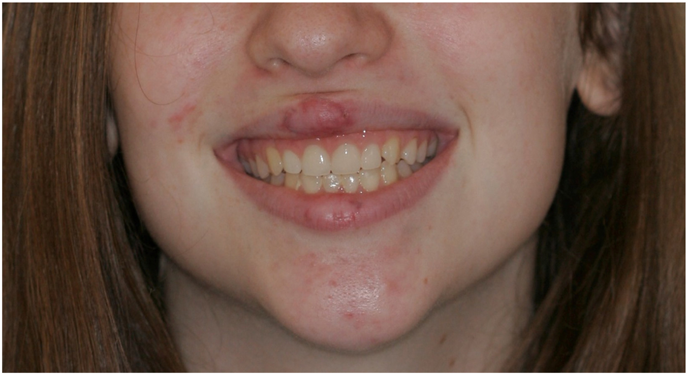 A clinical photograph of a teenage patient smiling with a dental flipper replacing missing upper front teeth.