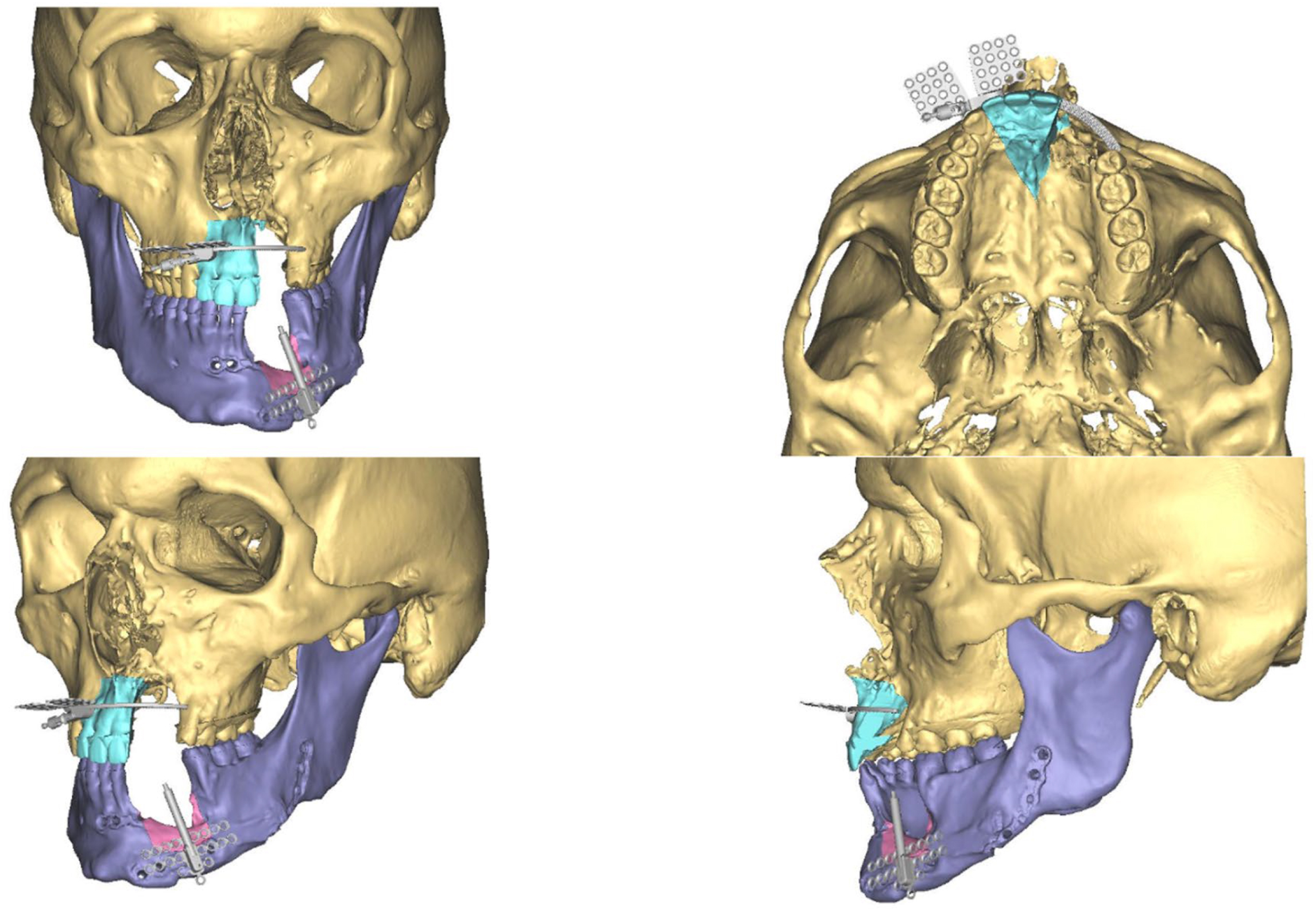 A four-panel digital 3-dimensional skull rendering demonstrates surgical planning for moving cut segments of the upper and lower jaw bones forward using metal pins to rebuild facial structure.
