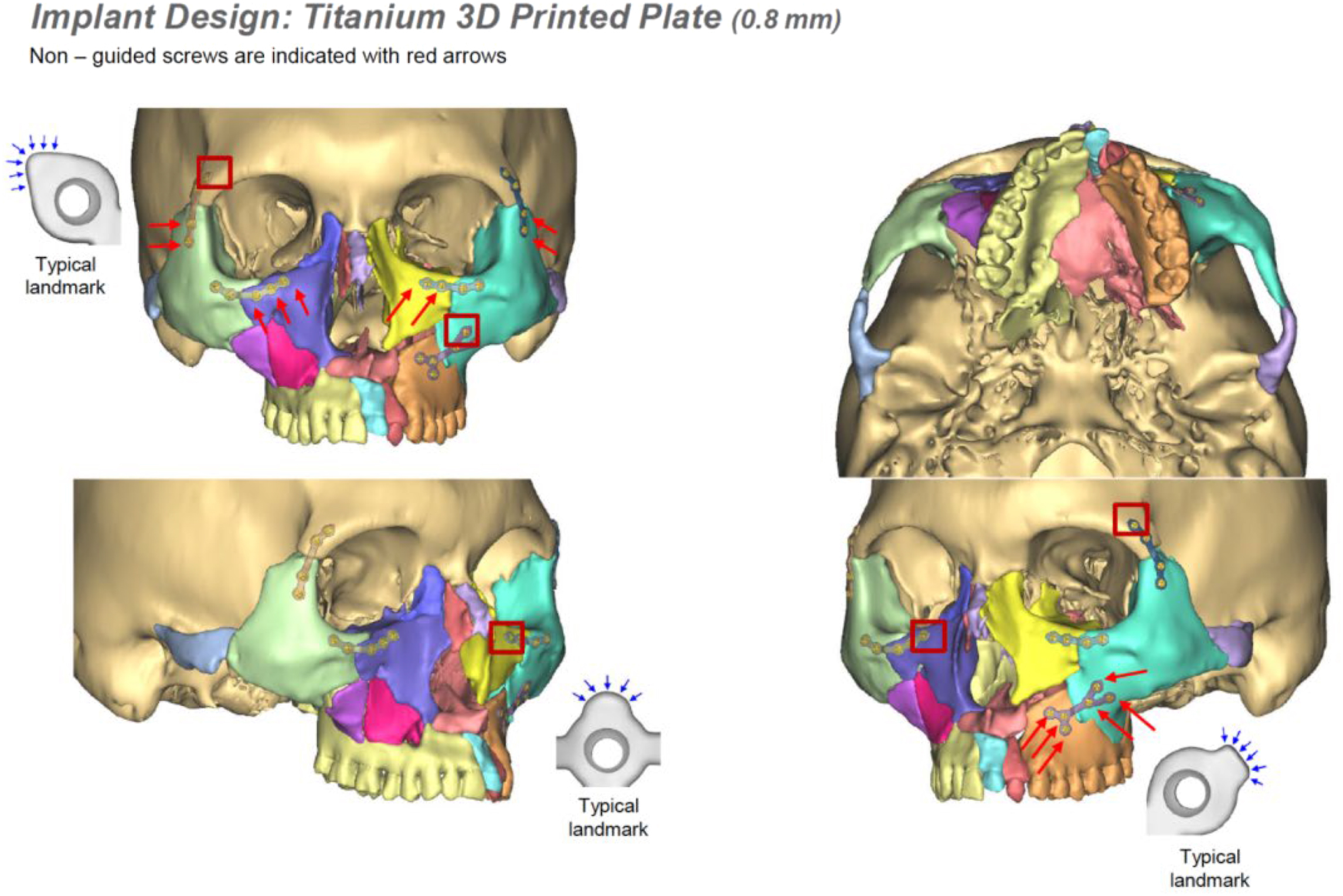 A four-view composite of C T reconstruction scans depicts five custom three-dimensional printed titanium plates positioned following pre-drilled screw hole locations with landmark markers.