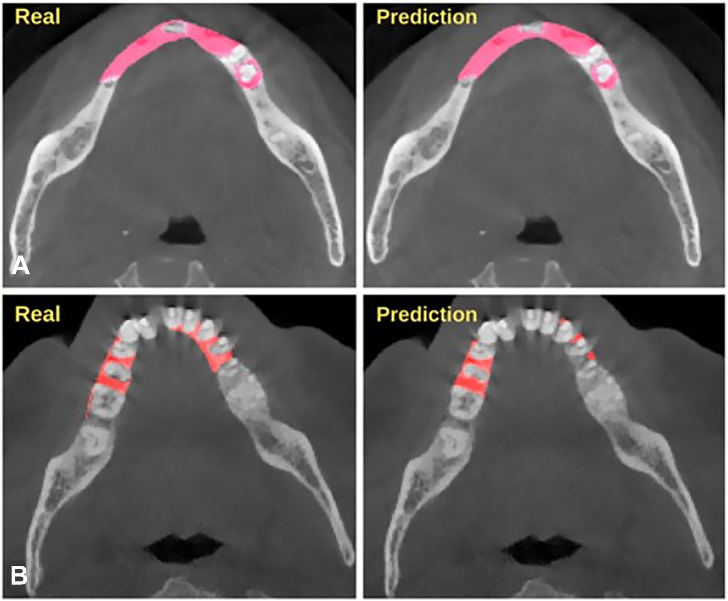 A set of axial cone beam C T slices demonstrates automatic segmentation of periodontal problems by comparing real ground truth masks with D L model predictions.