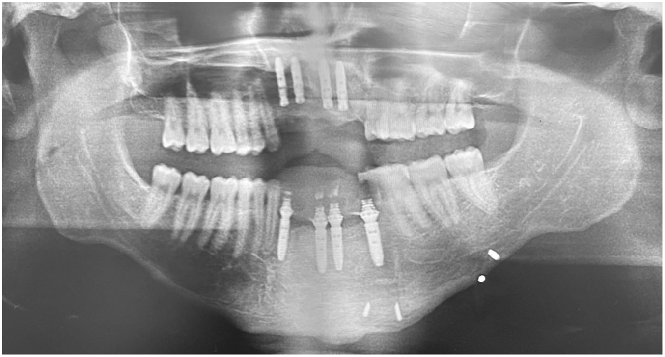 A panoramic dental X-ray shows multiple titanium dental implants placed in the upper and lower front jawbones, along with residual surgical screws in the chin area.