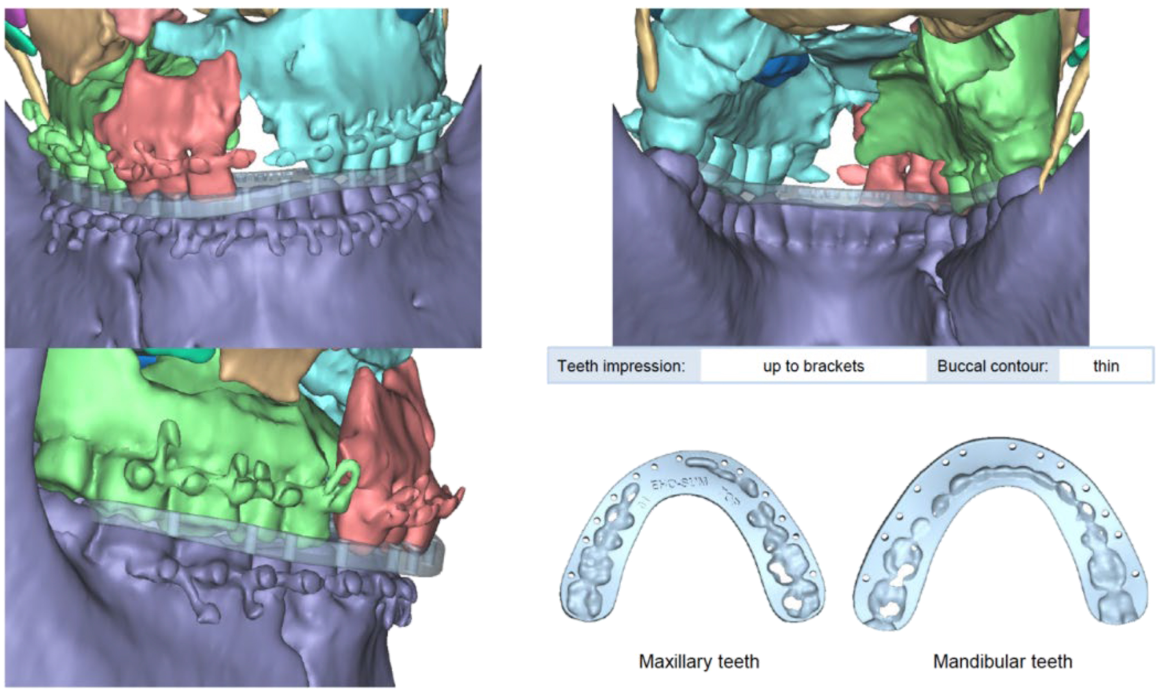 A composite of C T reconstruction scans and occlusal splint diagrams depicts surgical splint planning with teeth impression depth, buccal contour, maxillary teeth, and mandibular teeth.