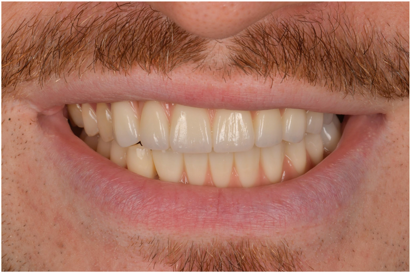 A close-up oral view of a man with a perfectly aligned, bright set of upper and lower artificial teeth showing an excellent esthetic result.