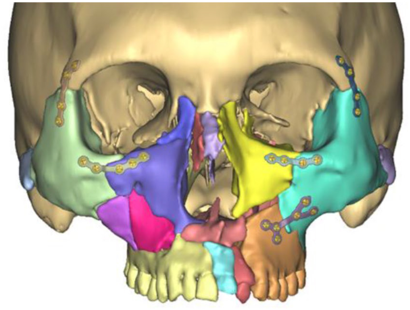 A frontal three-dimensional C T reconstruction scan depicts color-segmented repaired midface fracture subunits in reconstructed positions with labeled screw fixation sites.