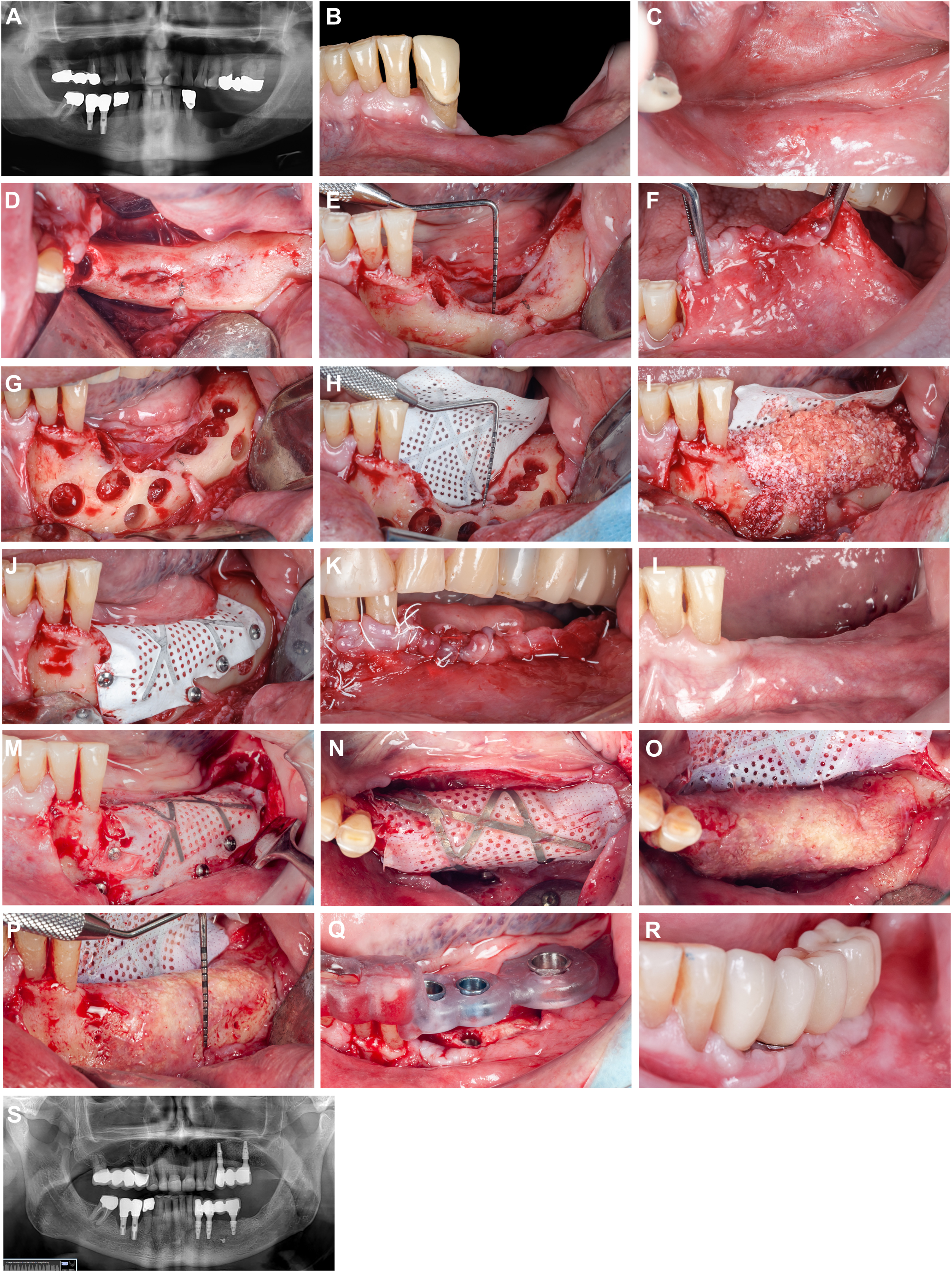 Seventeen clinical photos and two radiographic images show a jaw with teeth, gum tissue, tools, perforated membrane, autogenous bone chips, fixation pins, sutures, and implants.