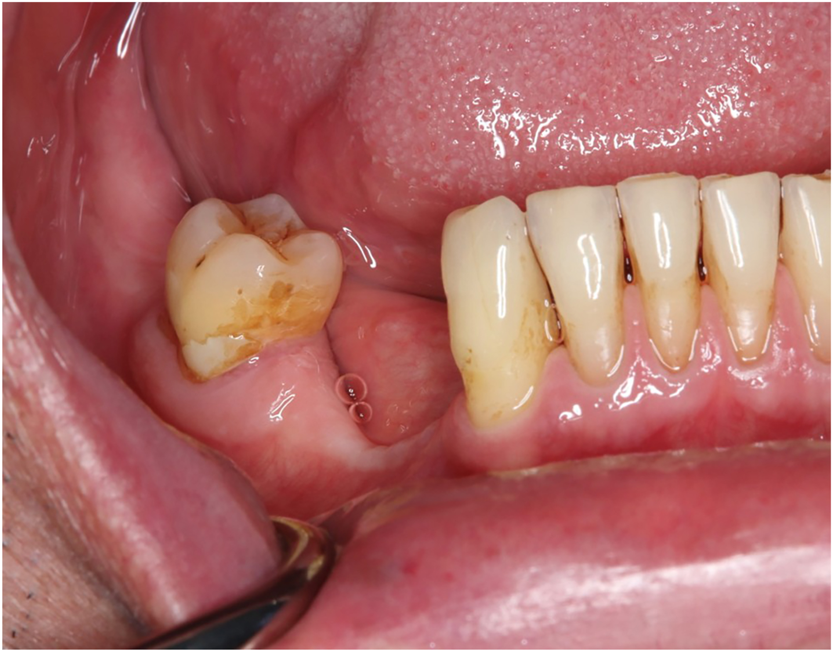 A close up intraoral photograph shows a malpositioned third molar, which is planned for extraction to facilitate grafting, next to an edentulous space and other teeth.