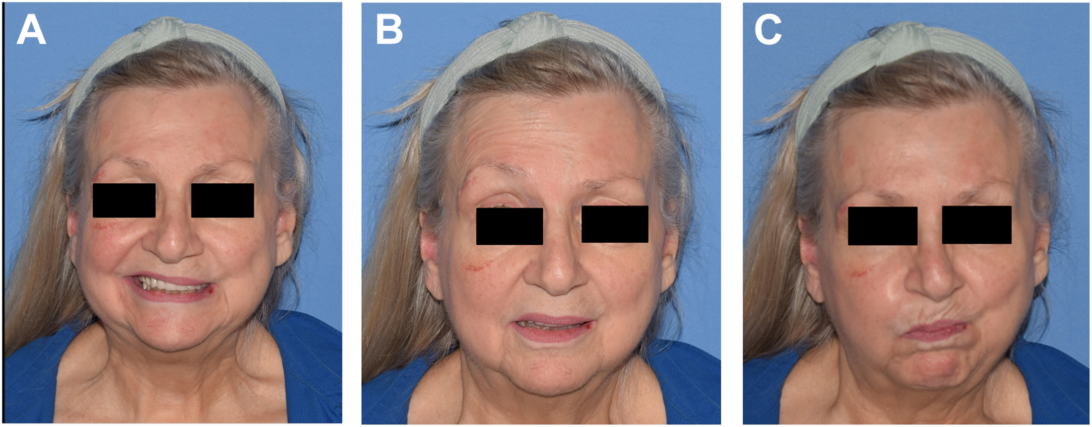 Alt text begins. Three clinical photographs show an older female patient with redacted eyes with left facial asymmetry and restricted mouth movement, indicative of facial nerve damage following T M J surgeries. Alt text provided by Elsevier.