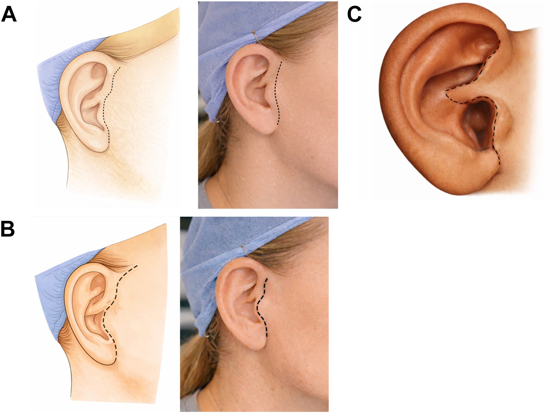 Alt text begins. A three-panel view shows the representative incision designs for open temporomandibular joint surgery, including pre-auricular endaural and invis-incision approaches. Alt text provided by Elsevier.