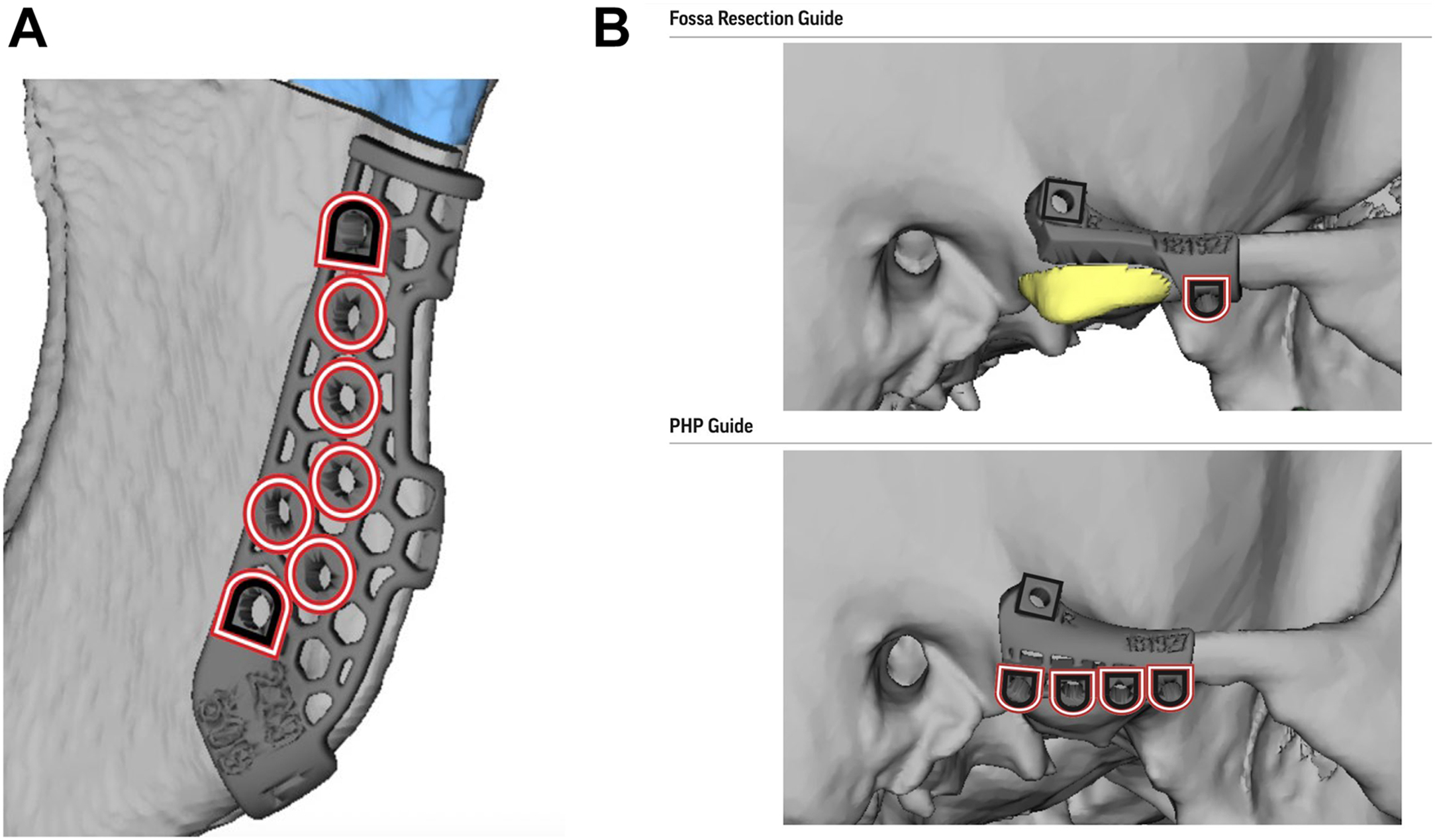 Alt text begins. A two-part three-dimensional surgical planning illustration demonstrates ramus, fossa resection, and prosthetic head positioning guides along the temporomandibular joint region. Alt text provided by Elsevier.
