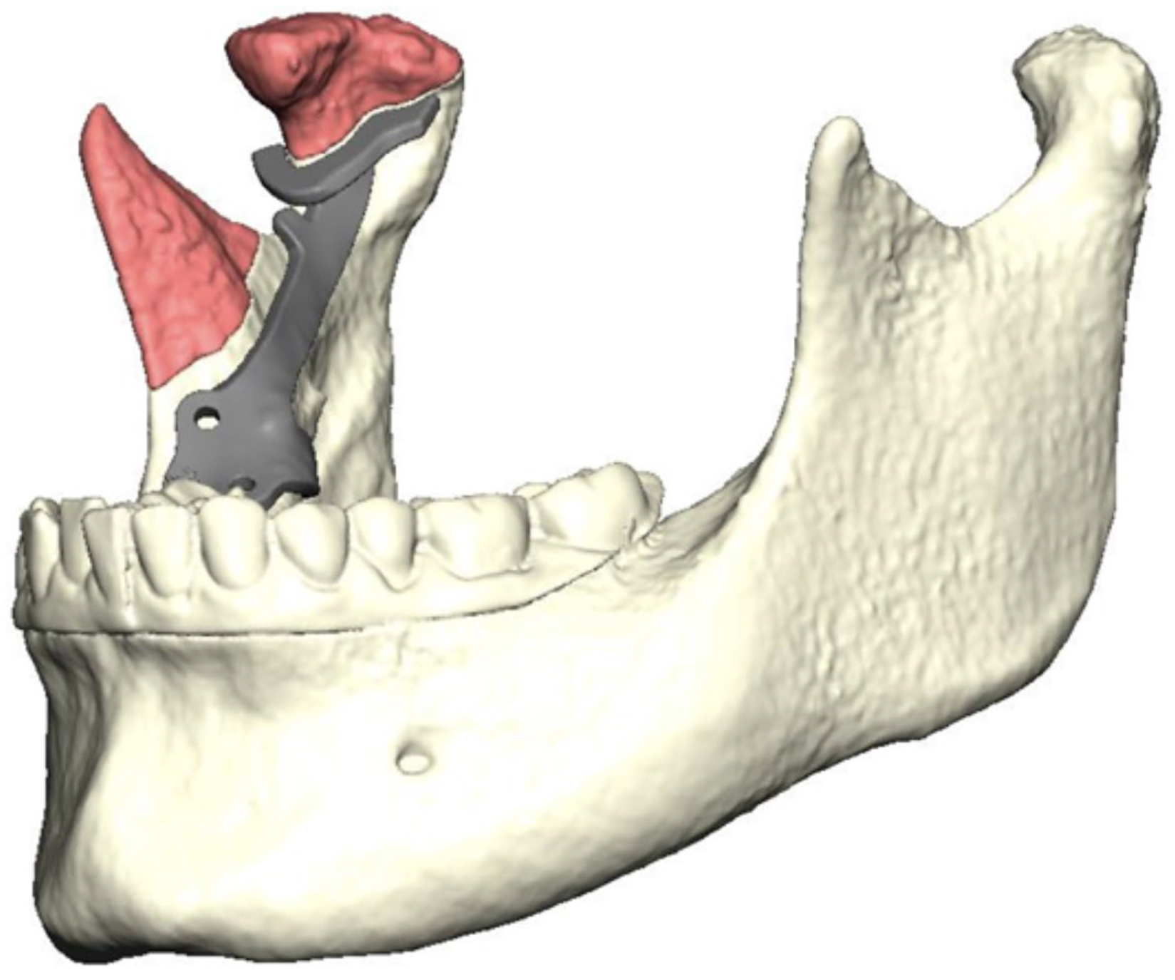 Alt text begins. A computer-aided design shows the surgical guide on the mandible for proportional condylectomy through an intraoral approach. Alt text provided by Elsevier.