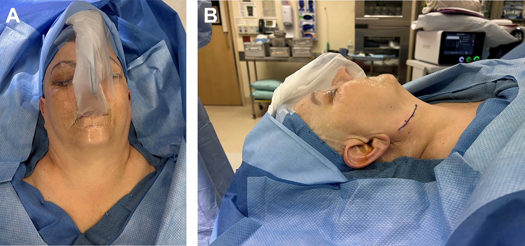 Two-panel intraoperative photograph. Panel A shows a metal surgical guide secured to the lateral mandibular ramus through an open incision. Panel B shows an endoscopic view of the guide closely conforming to the underlying bone.
