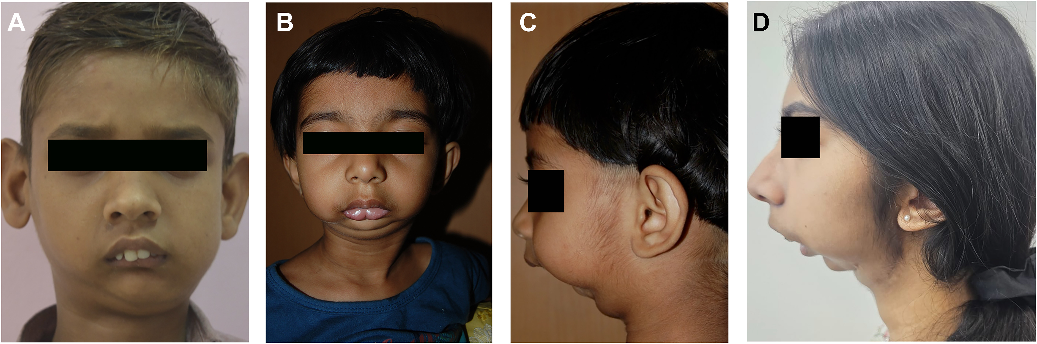Alt text begins. A two-panel preoperative clinical photograph shows pediatric patients with facial asymmetry, deviated chin, and mandibular retrognathia associated with temporomandibular joint ankylosis. Alt text provided by Elsevier.