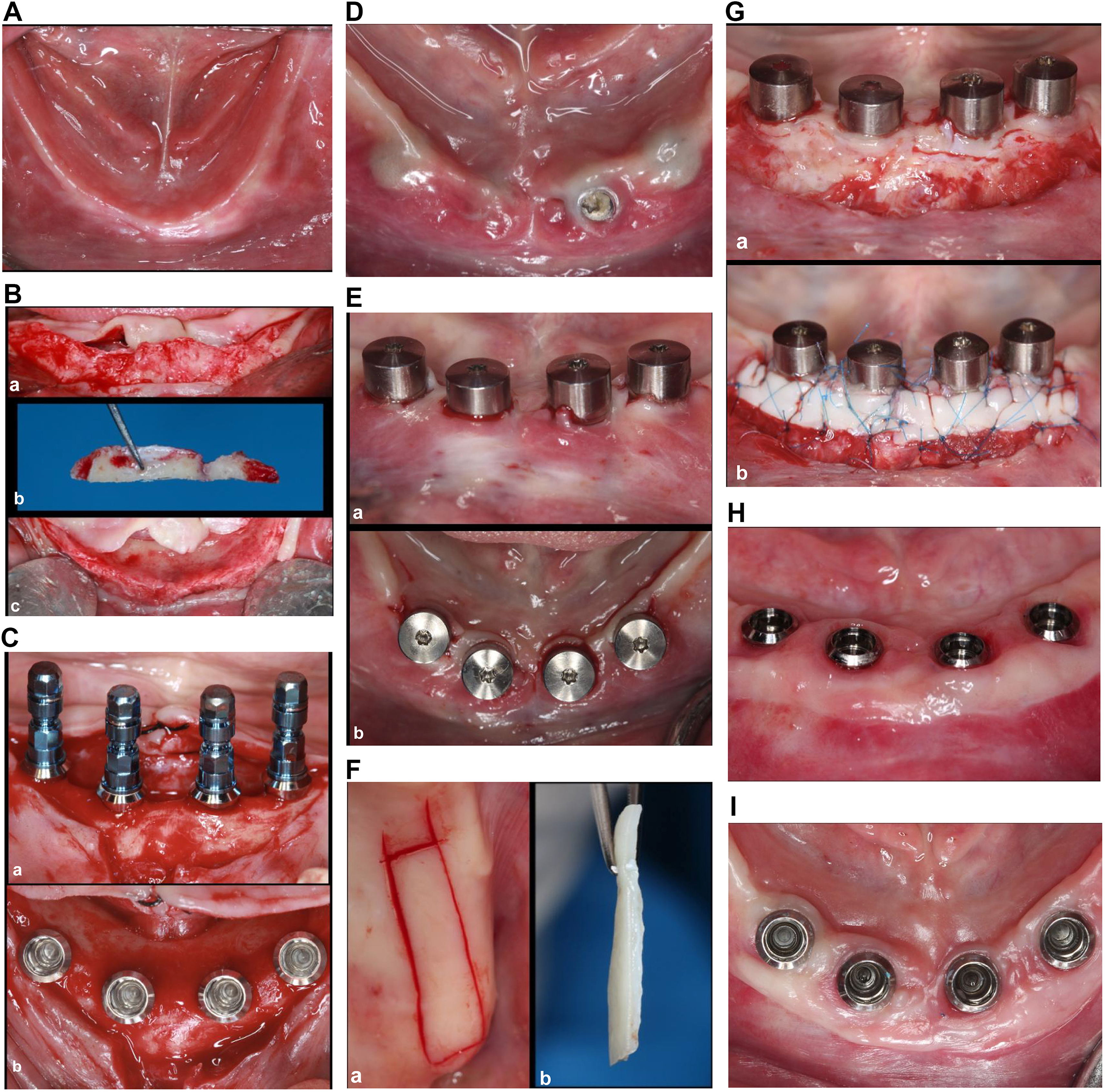 Several panels show sequential intraoral views of mandibular implants and associated soft tissue conditions.