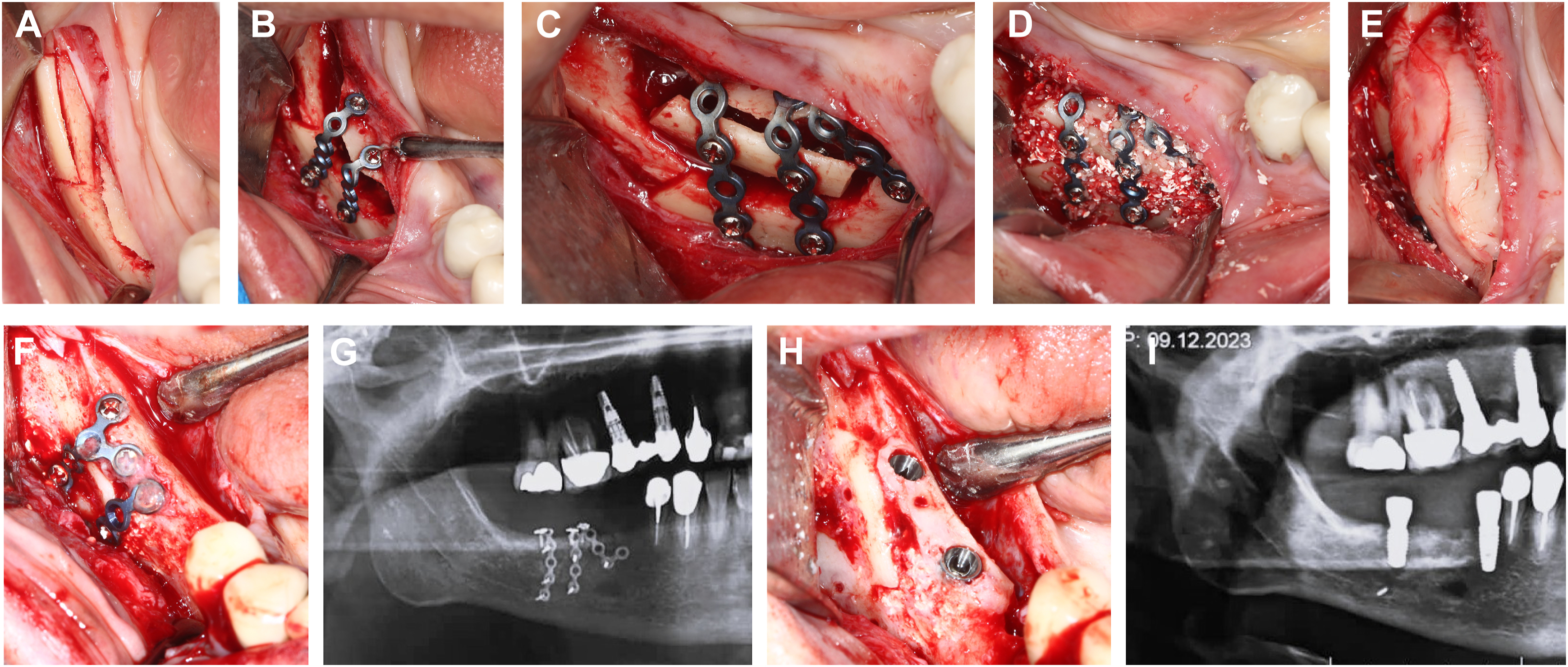 A set of nine panels shows stepwise mandibular surgery involving bone exposure, plate fixation, graft placement, and postoperative radiographs.