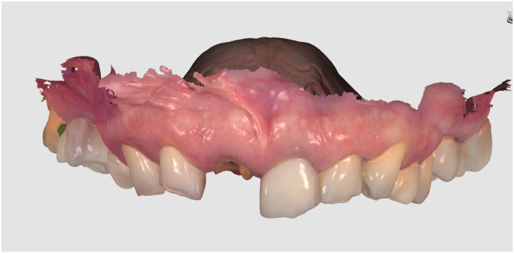 An intraoral digital scan shows the upper front teeth, surrounding gum tissue, and palatal contour with irregular gingival margins, one missing central tooth area, and exposed root surface.