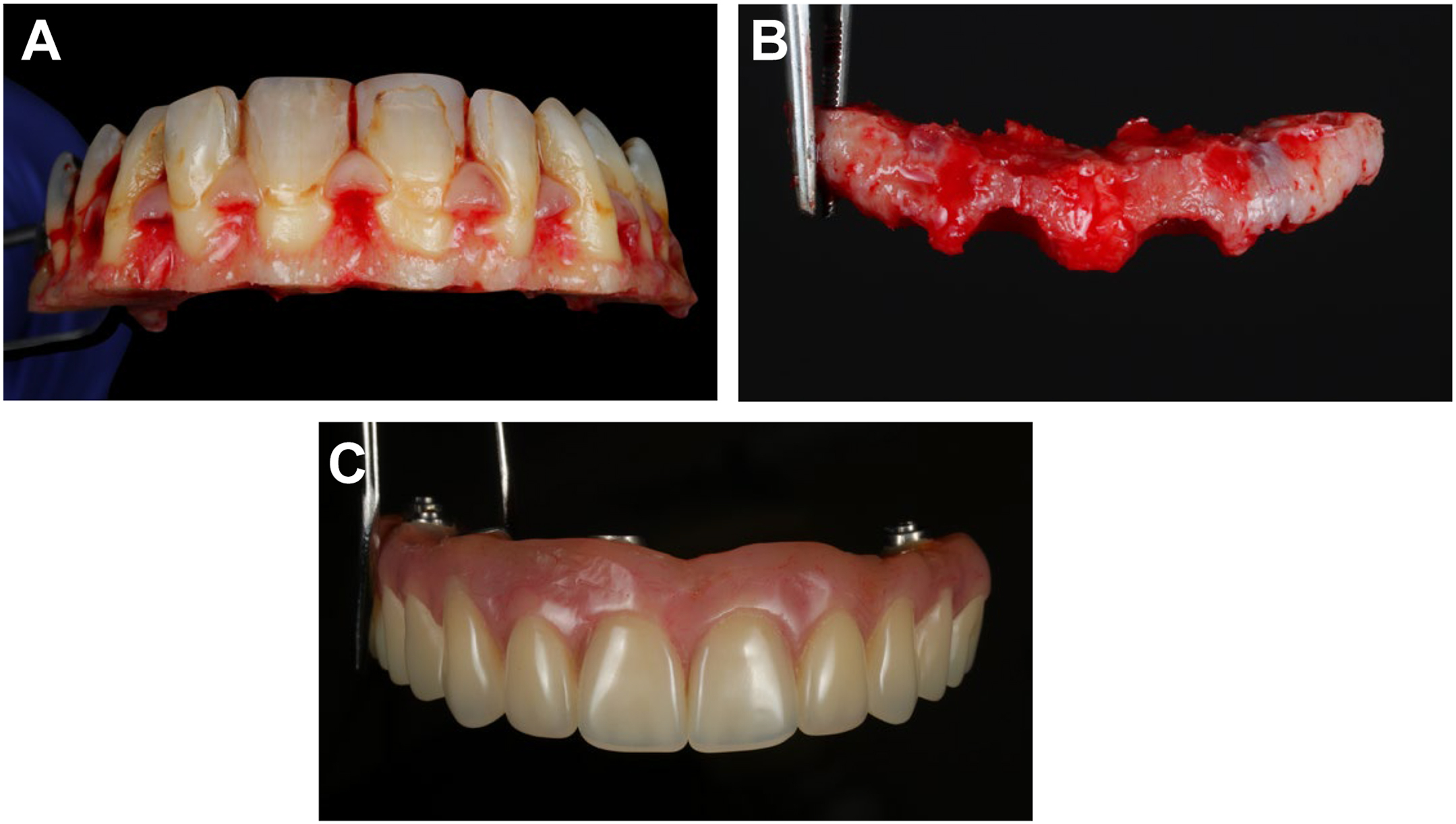 Three clinical photos show teeth with gum tissue, a bone structure with a tool, and a dental prosthesis with metal attachments across multiple stages.