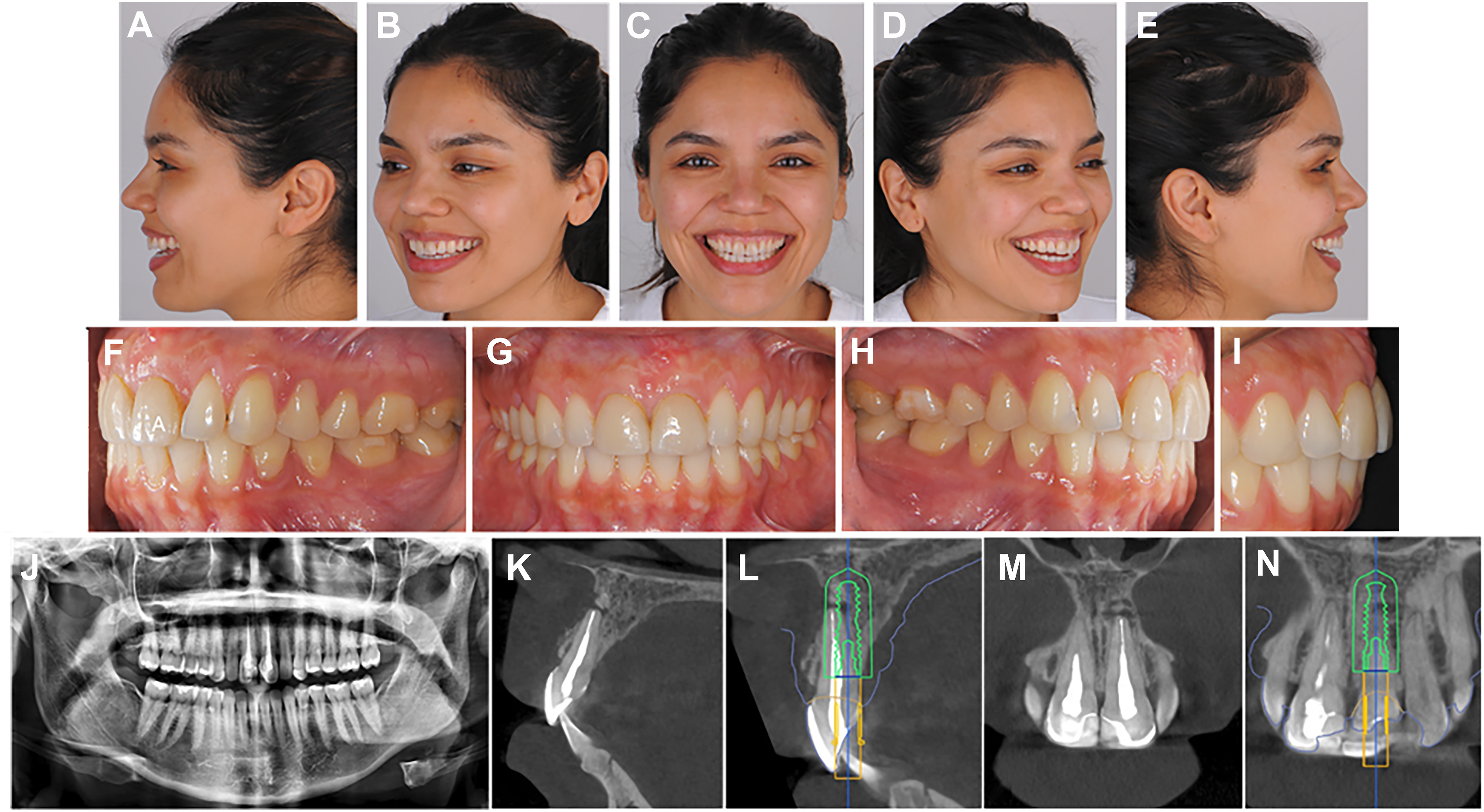 A set shows 14 panels, A to N, for an immediate dental implant. Panels A to E are facial photos, panels F to I are intraoral photos, and panels J to N are radiographs and C B C T scans.