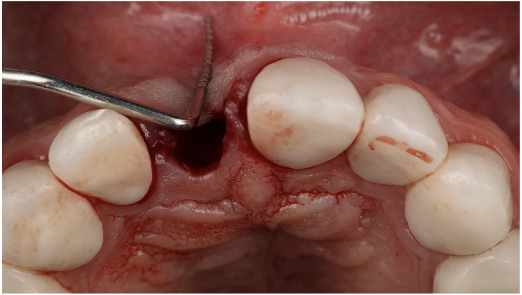 A close intraoral view shows the upper jaw with an empty tooth socket. A dental probe rests inside the socket. The gum tissue appears exposed with nearby teeth intact on both sides.