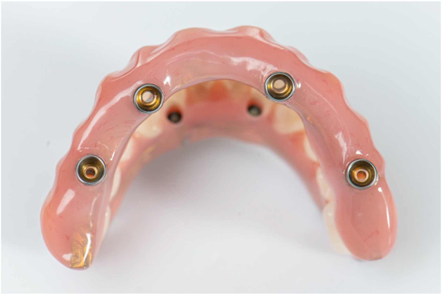 A photo of a dental prosthesis with four implant sites from left to right.
