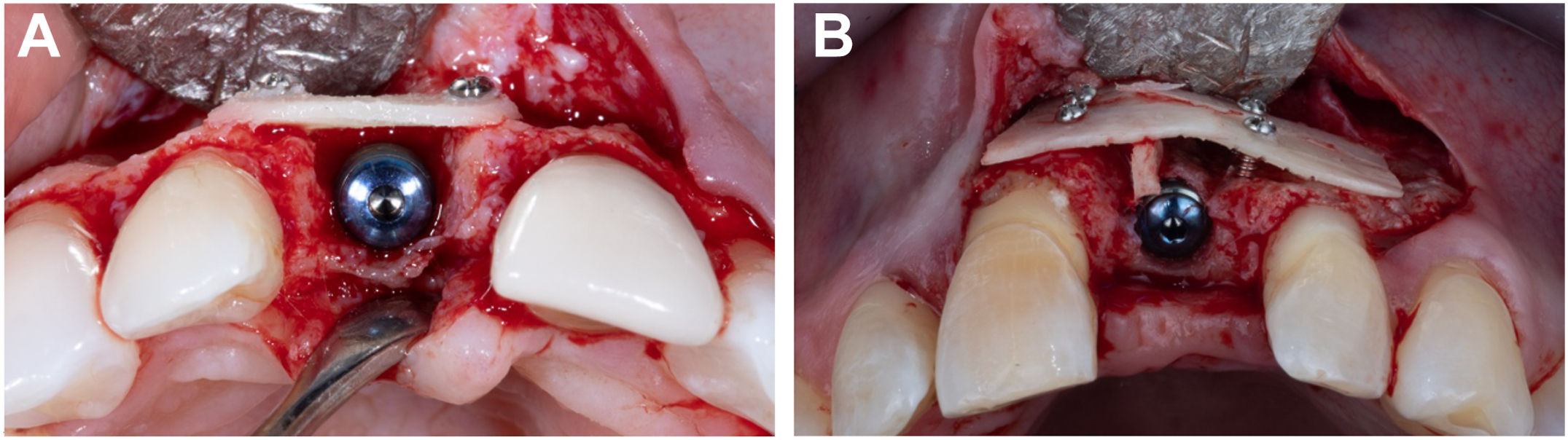 Two dental photos show a dental implant between maxillary incisors and a bending of a bone plate outward using a wedge to increase space for the placement of autogenous bone chips.