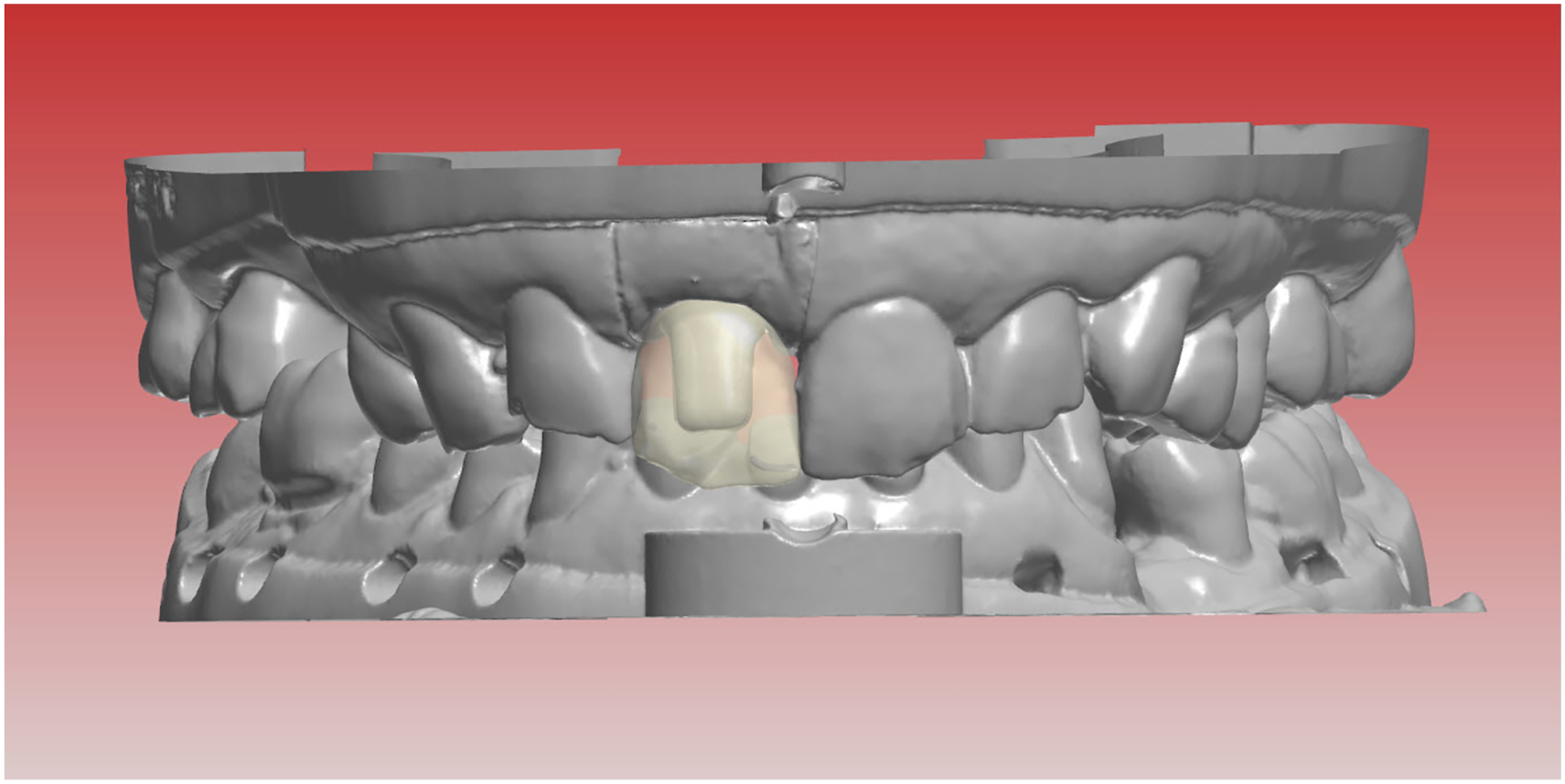 A digital 3 D dental model shows upper and lower arches in occlusion, with one highlighted upper front tooth representing a customized restoration design.