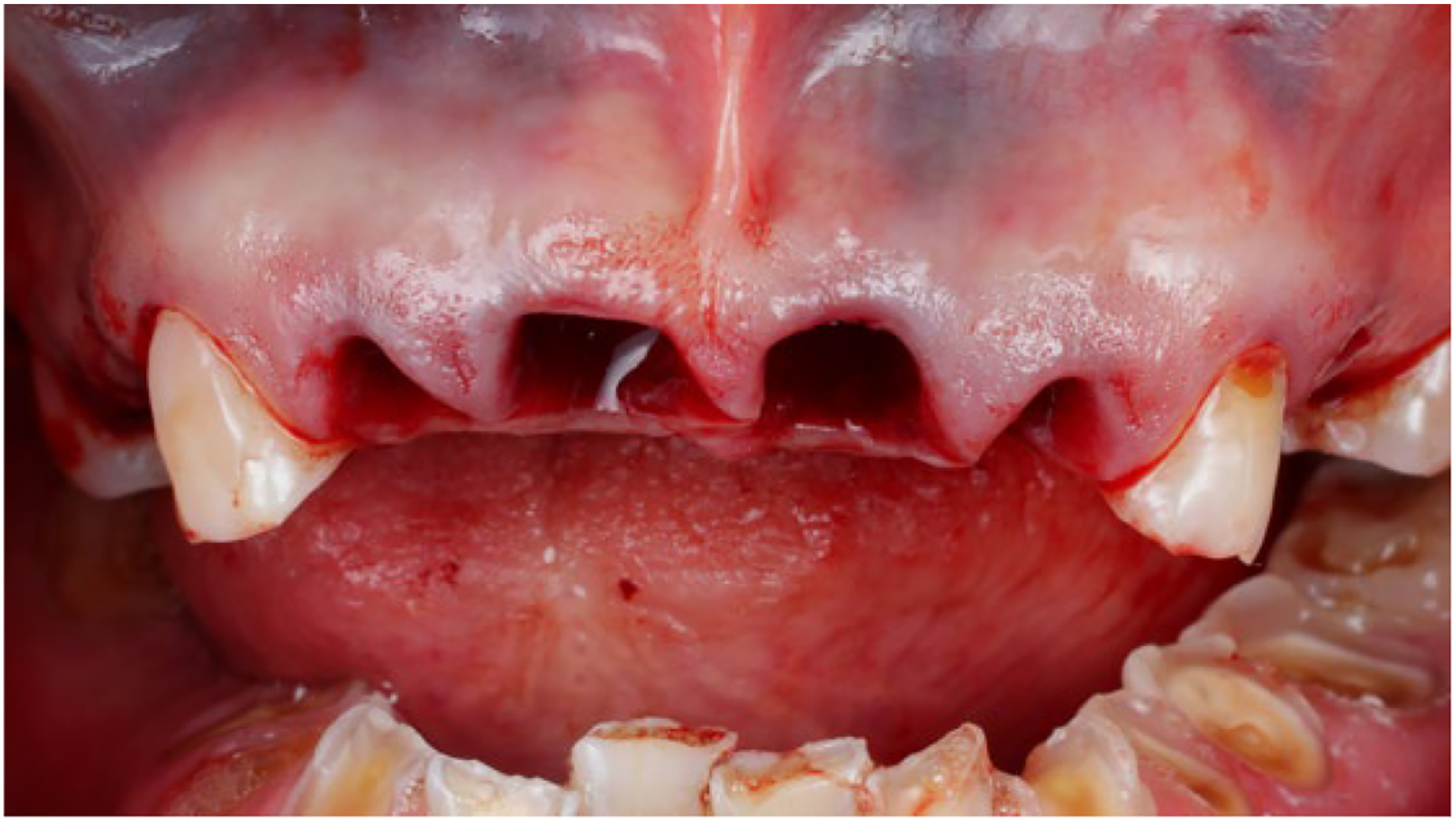 A clinical photo shows a patients open mouth with upper and lower teeth, revealing a flapless full arch implant surgery site.