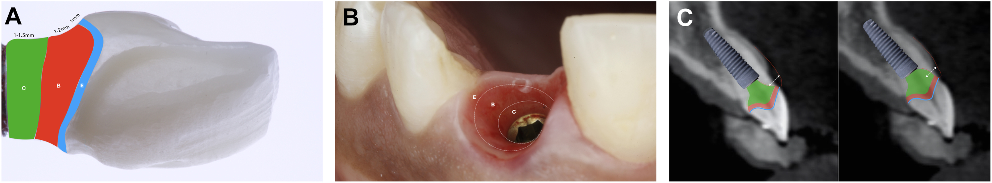 A set of three panels shows diagrams and clinical views illustrating E, B, and C zones in implant restoration.