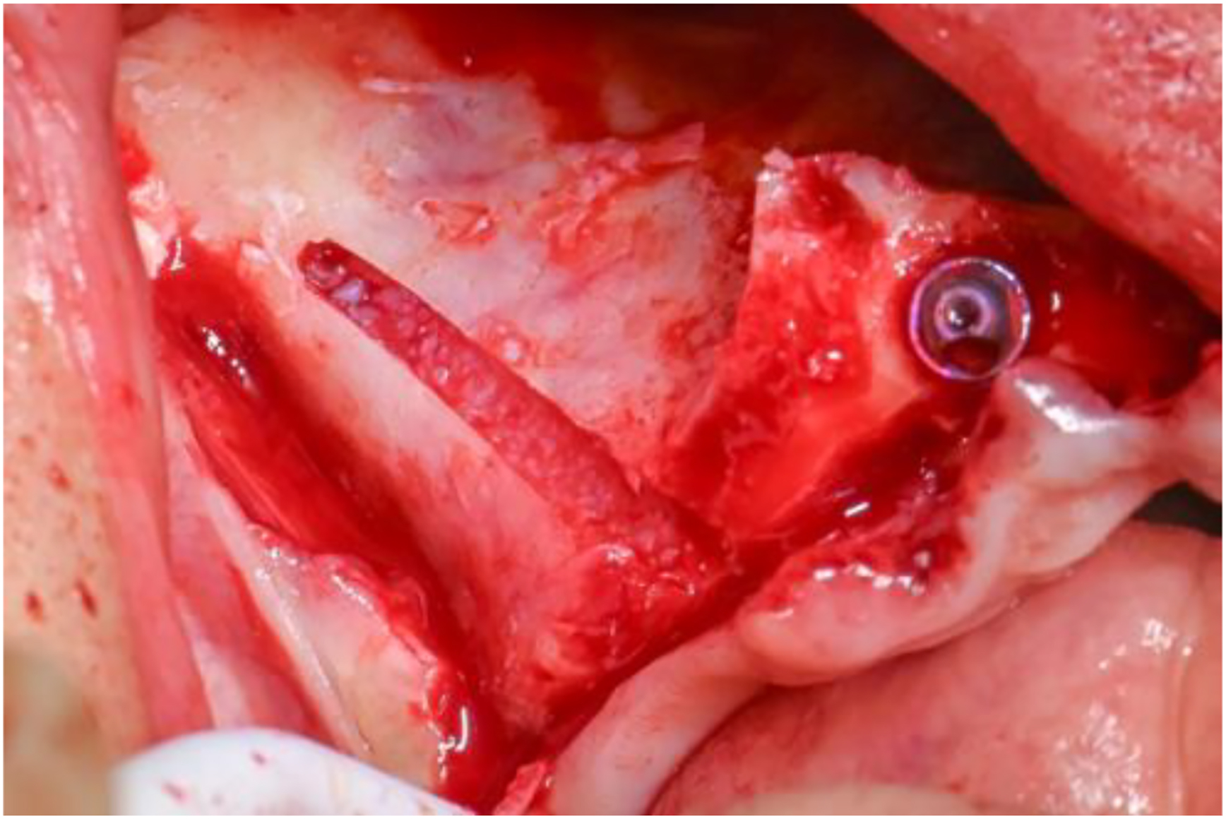 A photo of a surgical site with a slot lined with graft material and an implant.