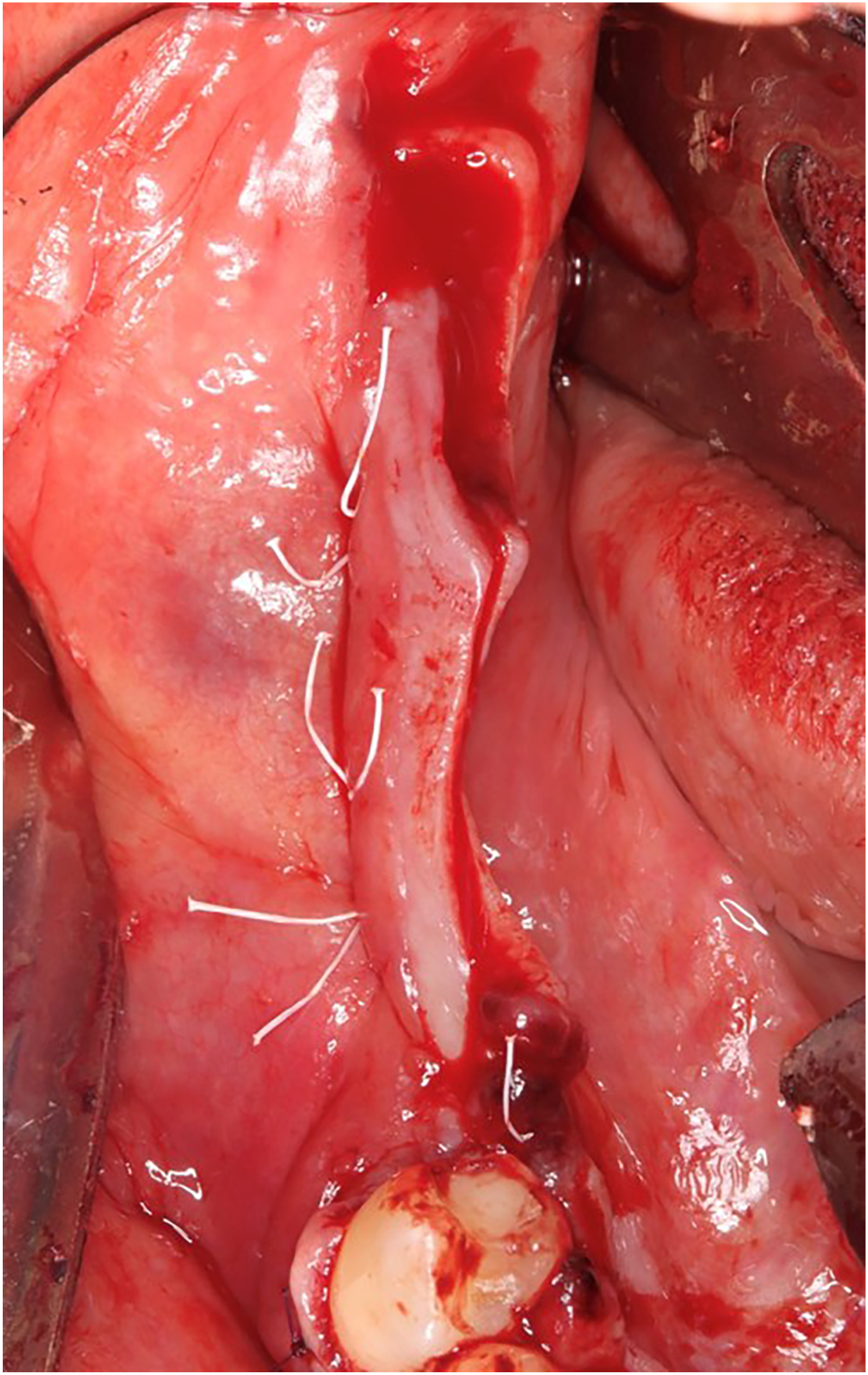 A surgical photo shows a collagen membrane positioned over a secured titanium mesh with several sutures along the exposed oral tissue.