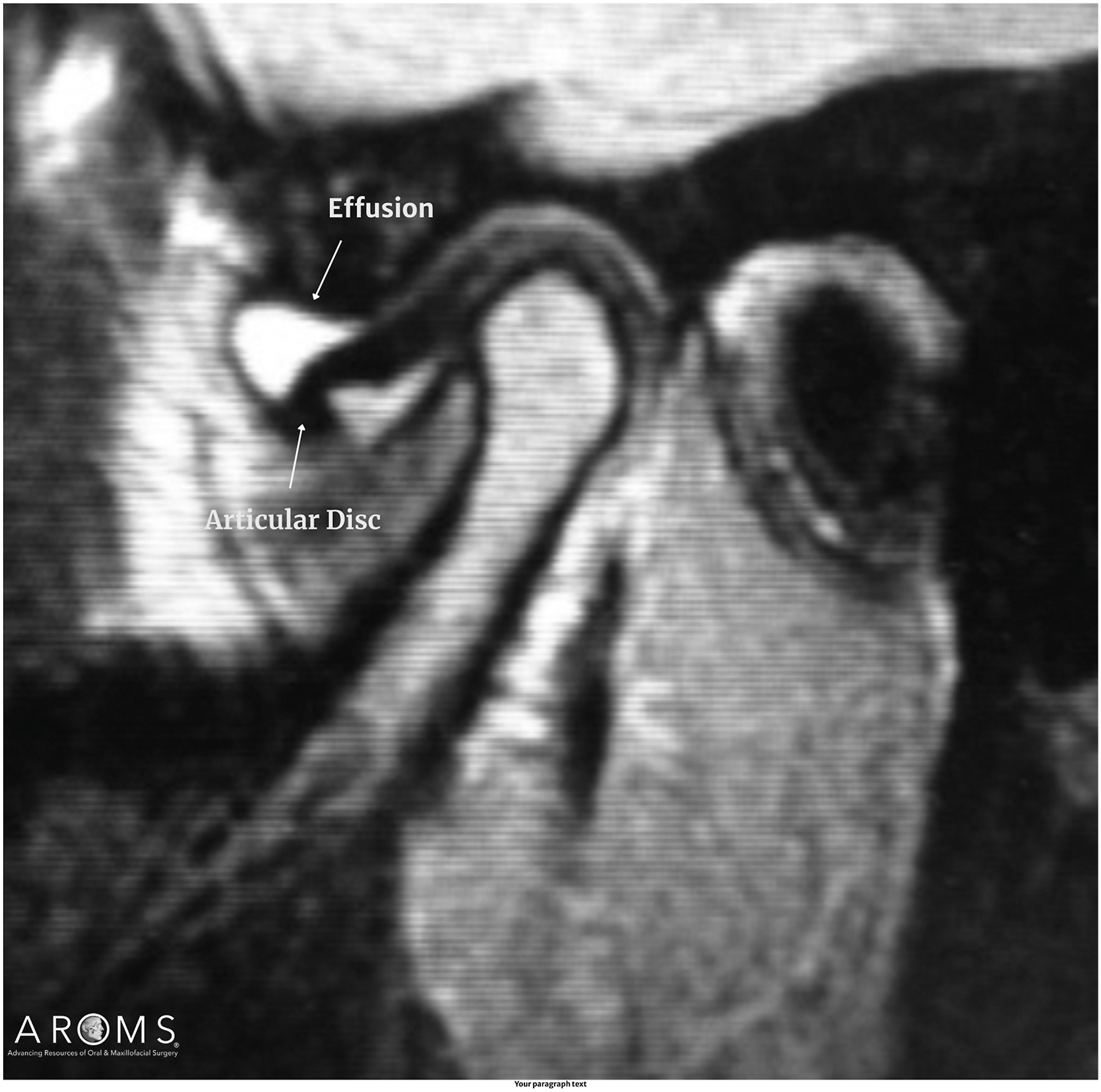 Alt text begins. An M R I of the temporomandibular joint in sagittal view with labeled articular disc and joint effusion. Alt text provided by Elsevier.