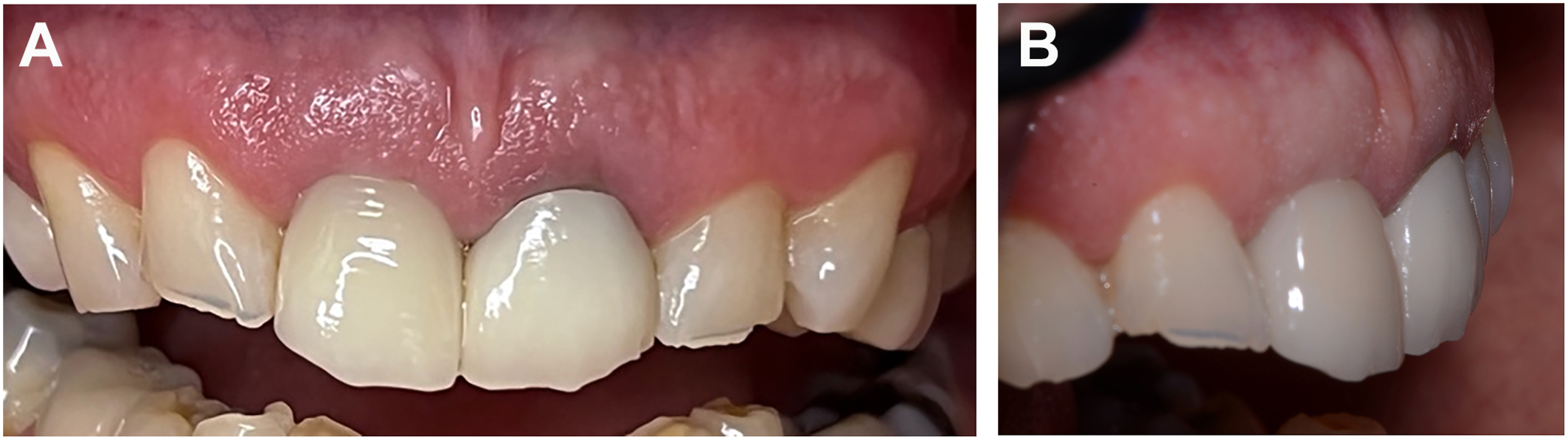 A pair of dental views shows a frontal view of upper front teeth with aligned crowns in section A and a lateral view displaying the same restored teeth and surrounding gum contour in section B.