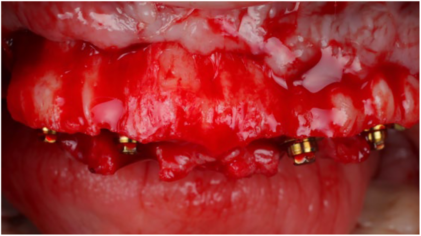 A clinical photo shows a patients upper jaw with a full-thickness flap reflected, exposing bone and implant sites.