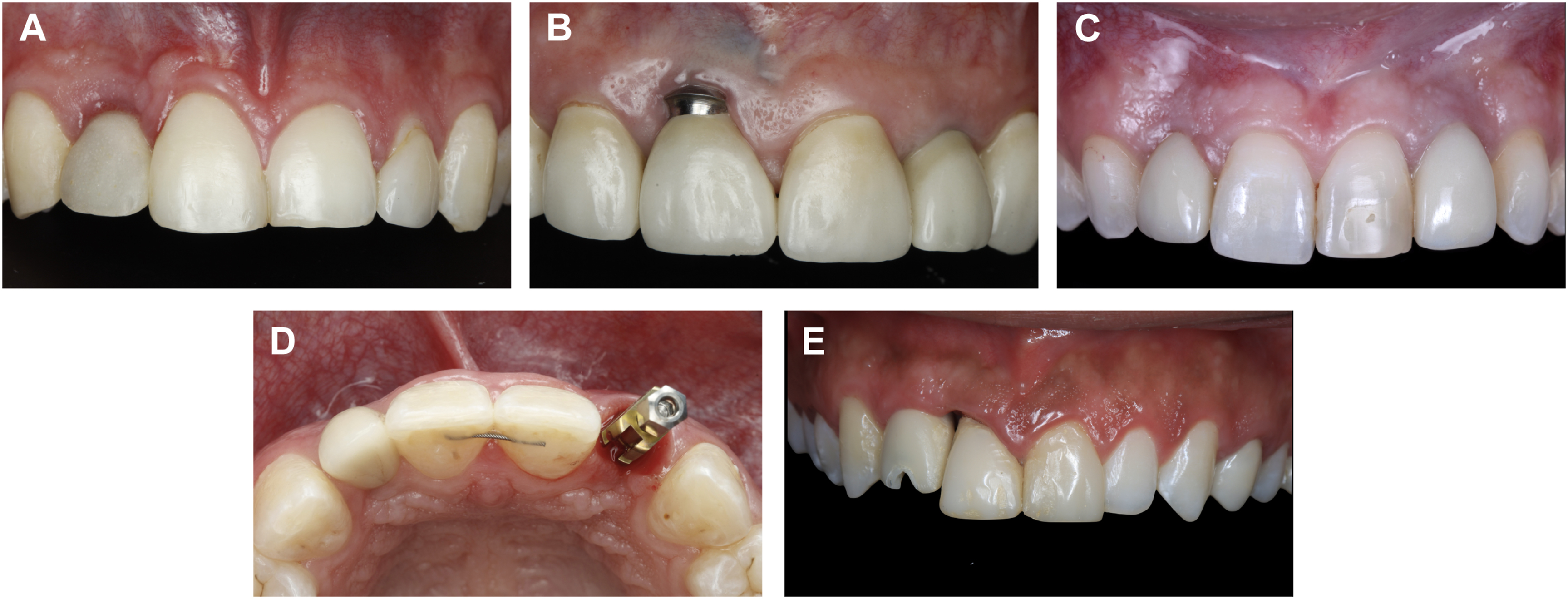 A set of five dental views shows changes in gum contour and implant positioning in the upper front region.