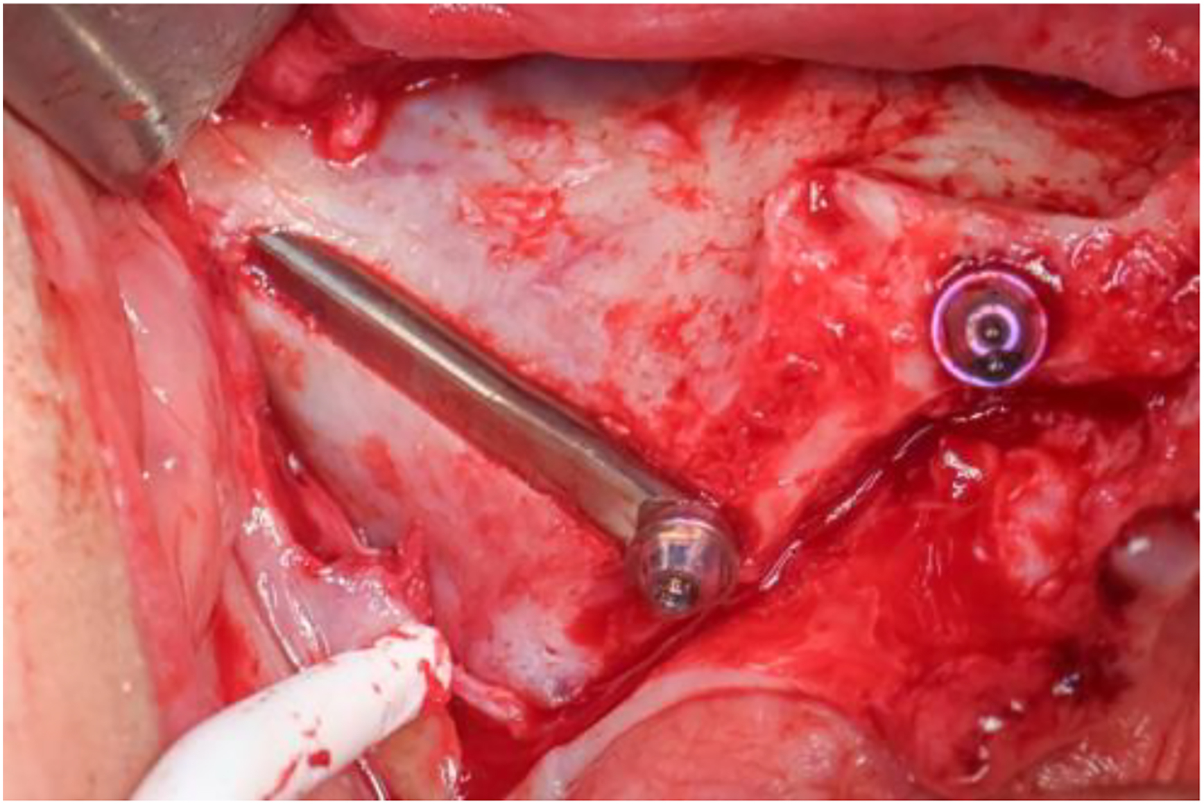 A photo of a surgical site with a Straumann Z A G A Flat Implant.