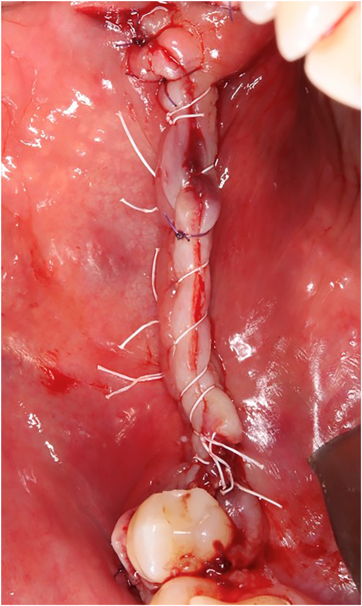 A surgical view of a collagen membrane covering a titanium mesh with interrupted sutures securing the soft tissue margins along the mandibular alveolar ridge.