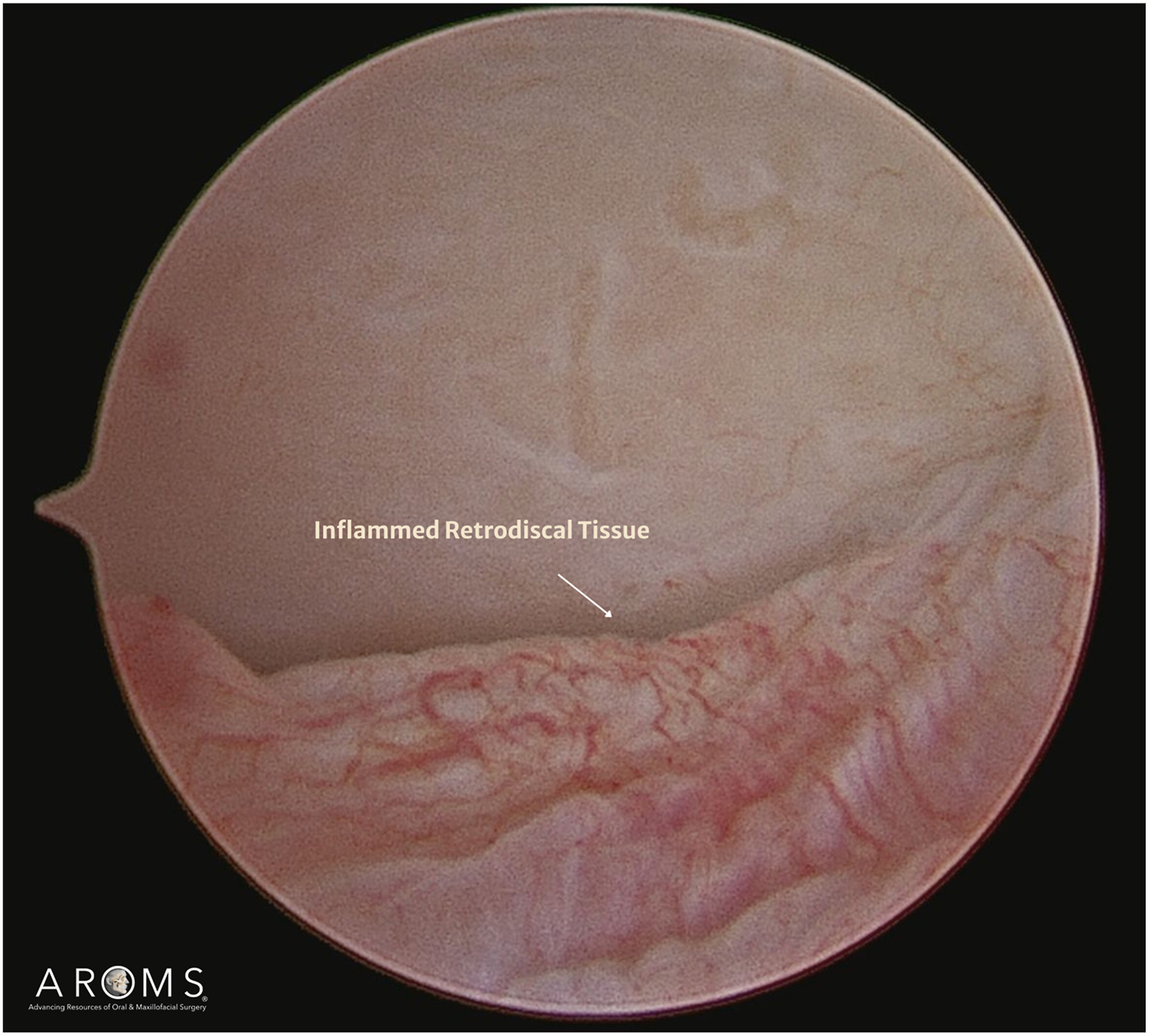 Alt text begins. An arthroscopic image of an intraarticular cavity with labeled inflamed retrodiscal tissue. Alt text provided by Elsevier.