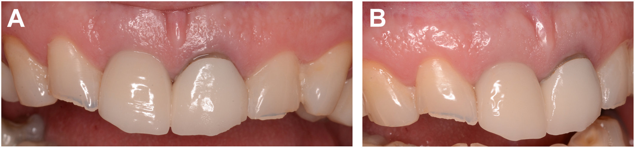 A pair of dental views shows a frontal view of upper front teeth with crowns in section A and a lateral view displaying the same teeth with restored surfaces and gum contour in section B.