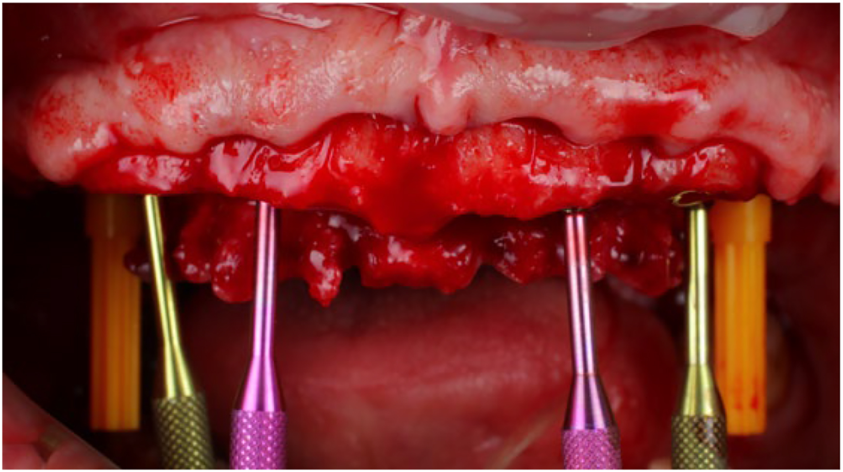 A clinical photo shows a patients upper jaw with straight and angled multi-unit abutments placed, including two dark and two light-shaded instruments.