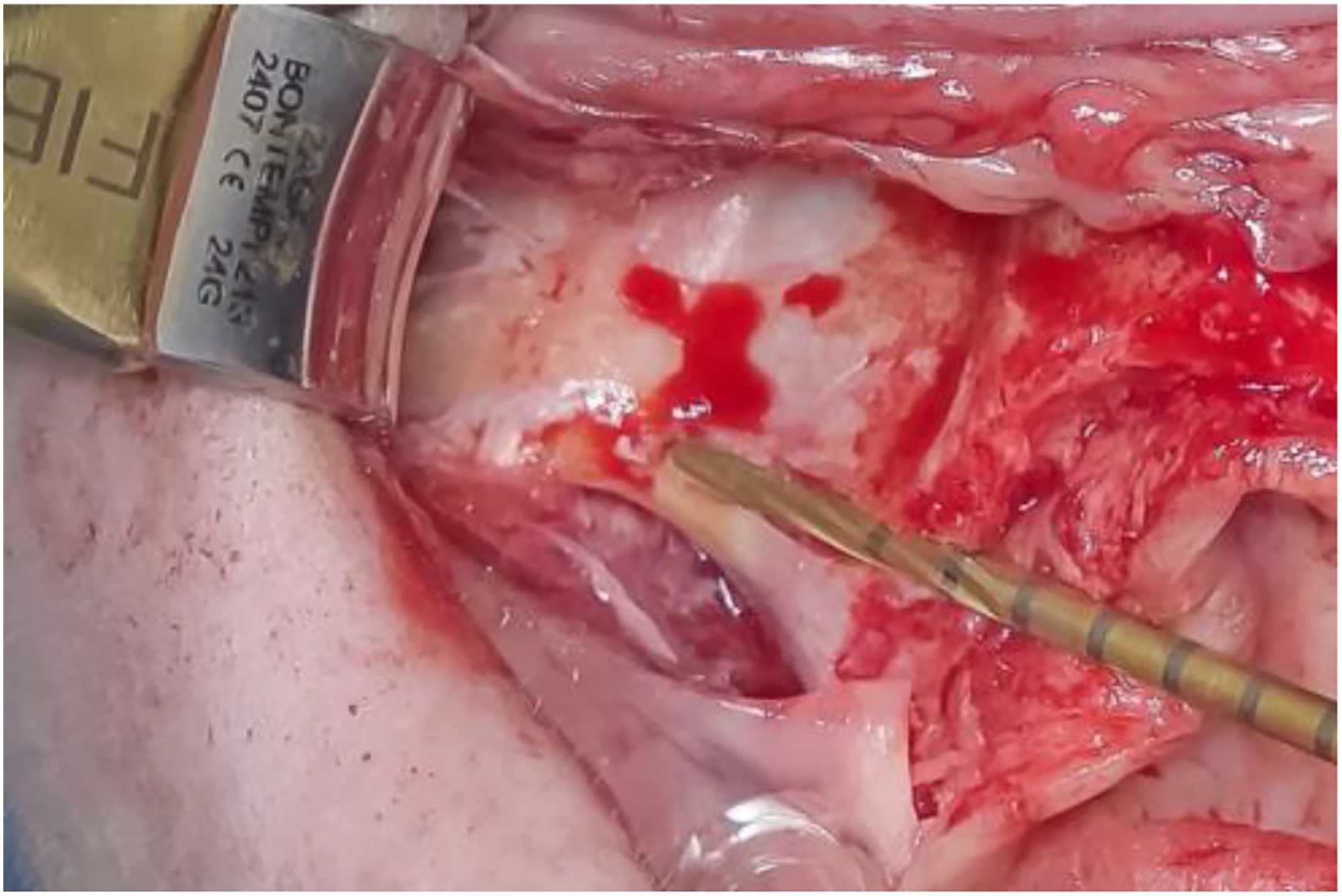 A photo of a surgical site with a concave lateral maxillary wall and a tool.